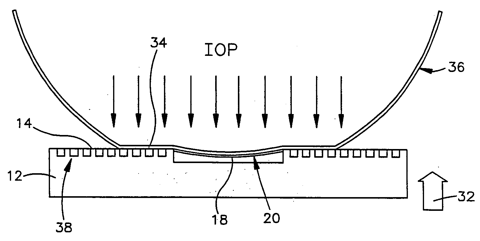 Intraocular pressure measurement system including a sensor mounted in a contact lens