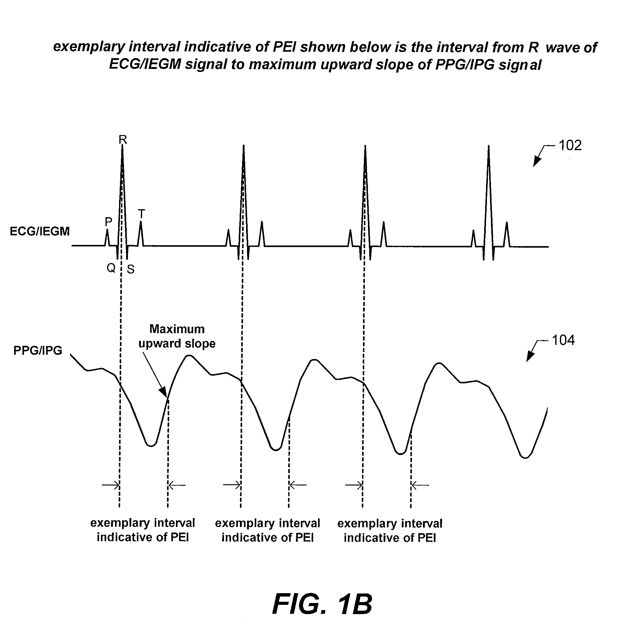 Pre-ejection interval (PEI) monitoring devices, systems and methods