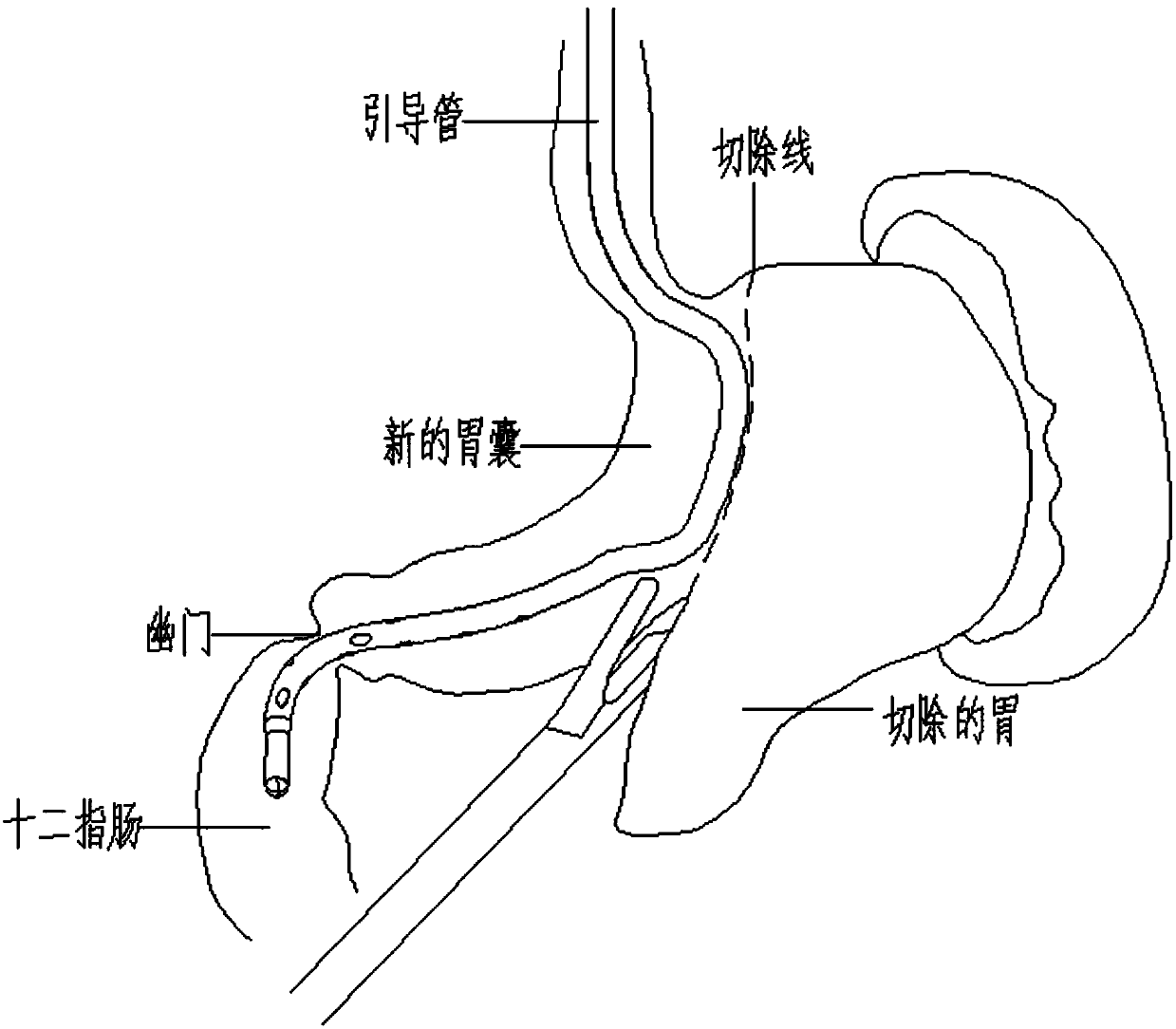 Guide tube special for laparoscopic sleeve gastrectomy