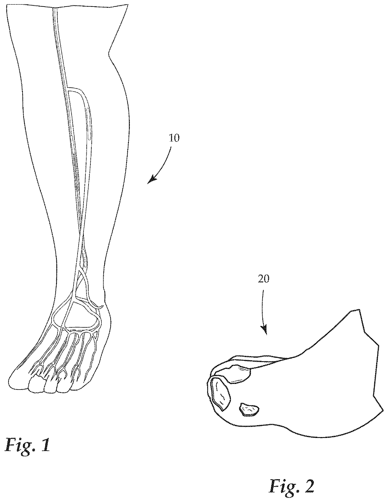 System and Method for Treating Critical Limb Ischemia (CLI) via the Superficial Femoral Arteries (SFA)