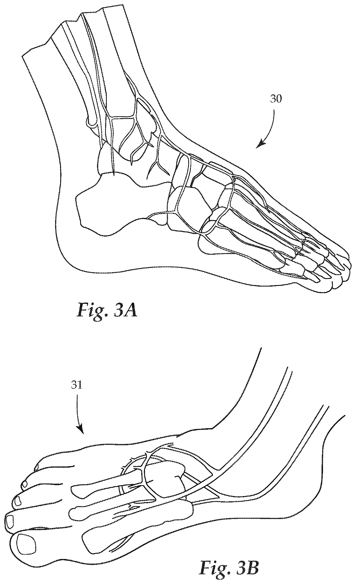 System and Method for Treating Critical Limb Ischemia (CLI) via the Superficial Femoral Arteries (SFA)