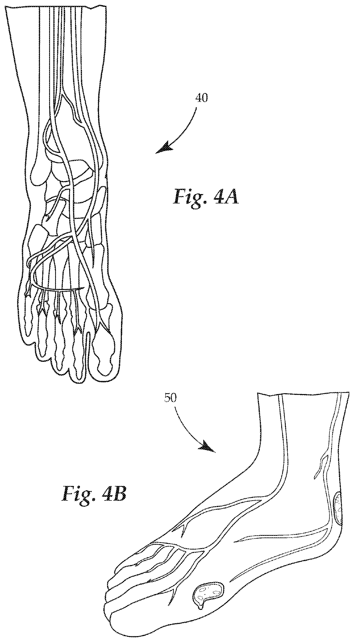 System and Method for Treating Critical Limb Ischemia (CLI) via the Superficial Femoral Arteries (SFA)