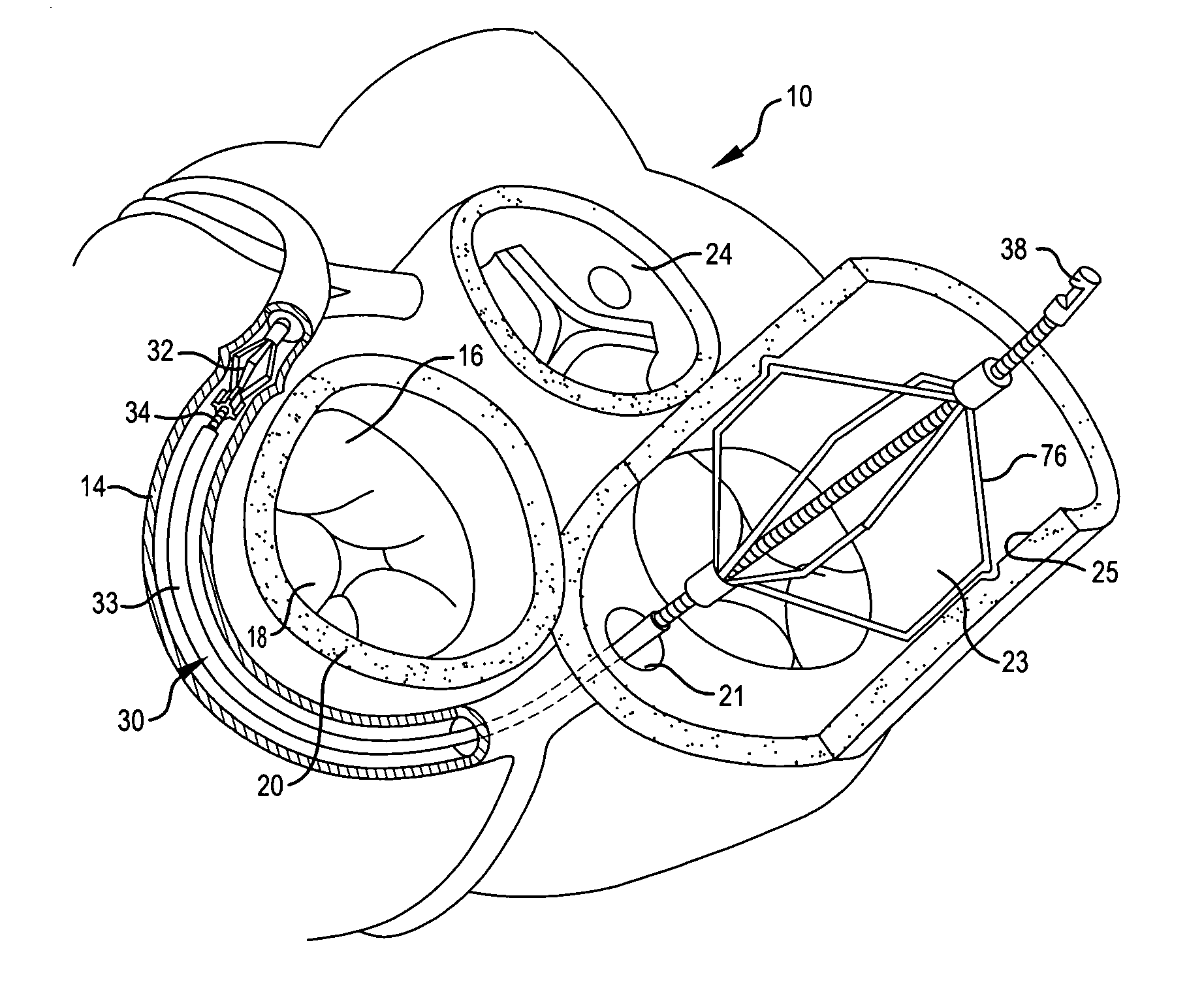 Anchor and pull mitral valve device and method