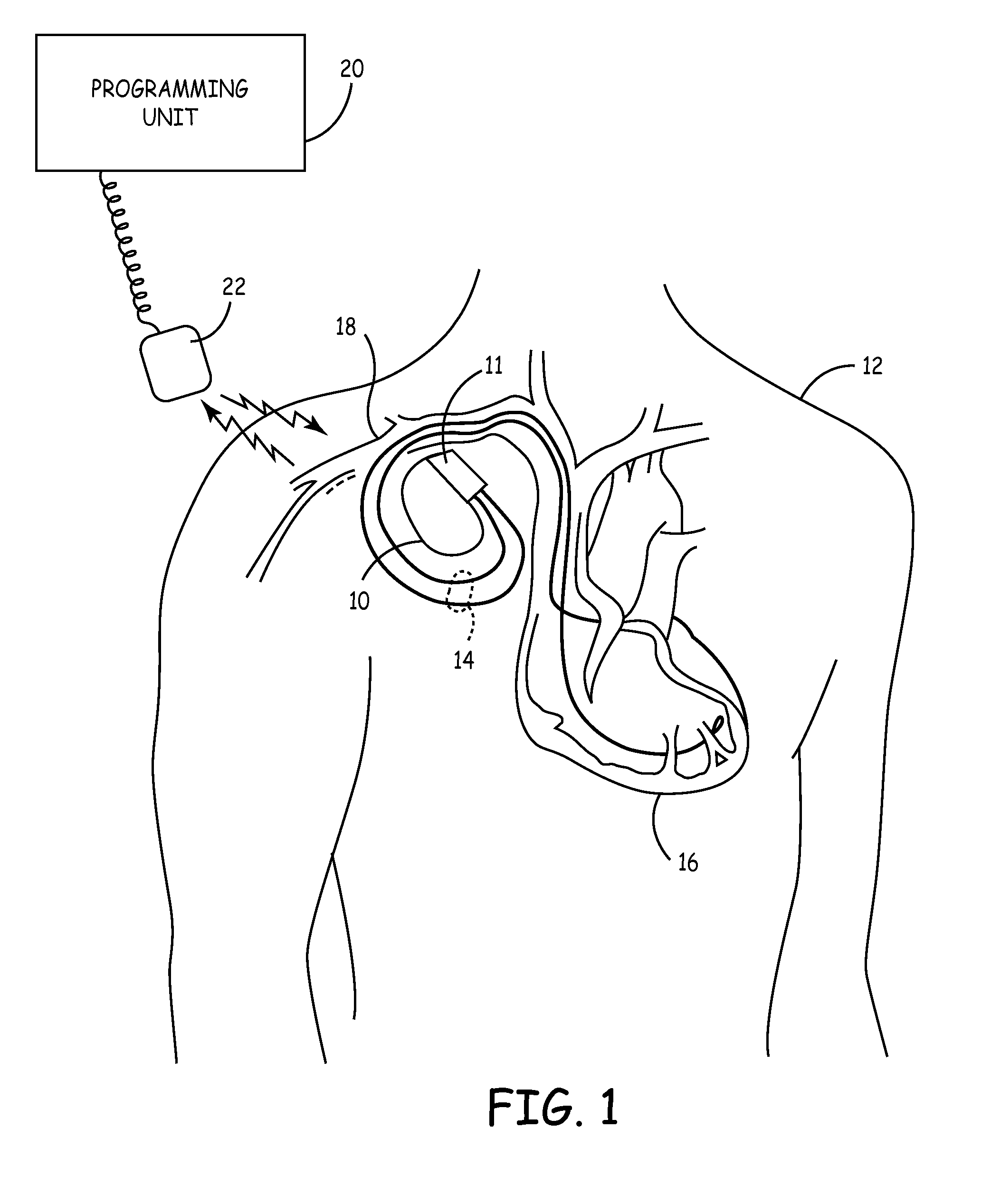 Atrial capture management in minimal ventricular pacing system and method