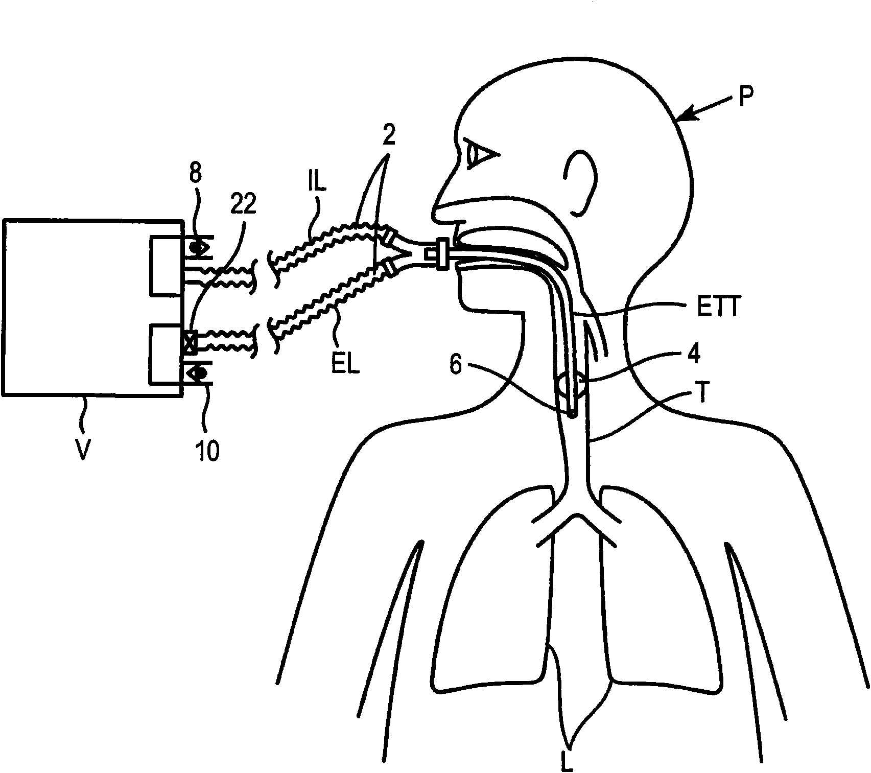 Methods and devices for providing inspiratory and expiratory flow relief during ventilation therapy