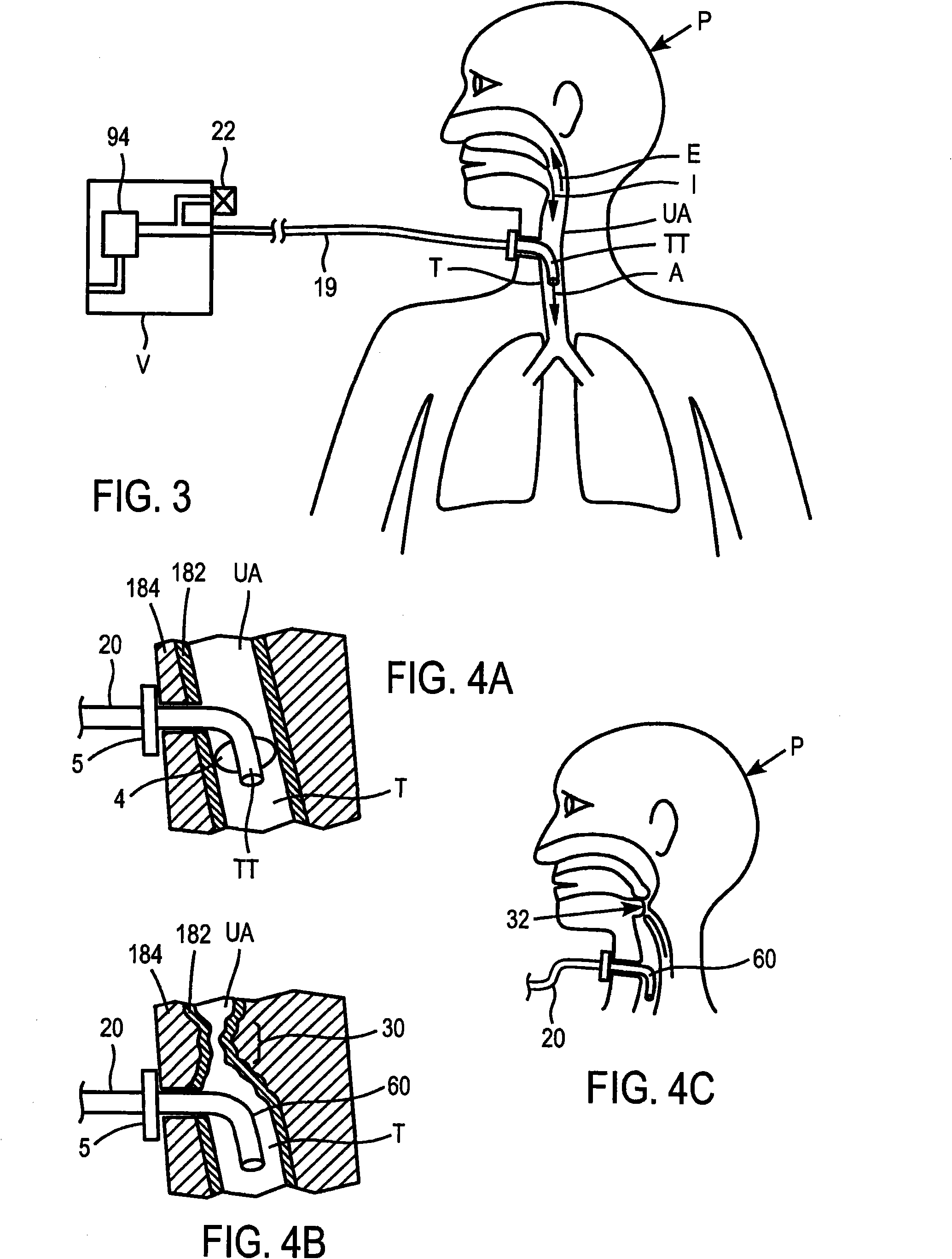 Methods and devices for providing inspiratory and expiratory flow relief during ventilation therapy