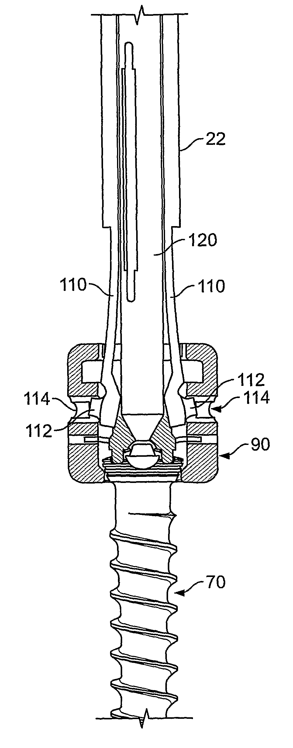 Apparatus and method for implantation of surgical devices