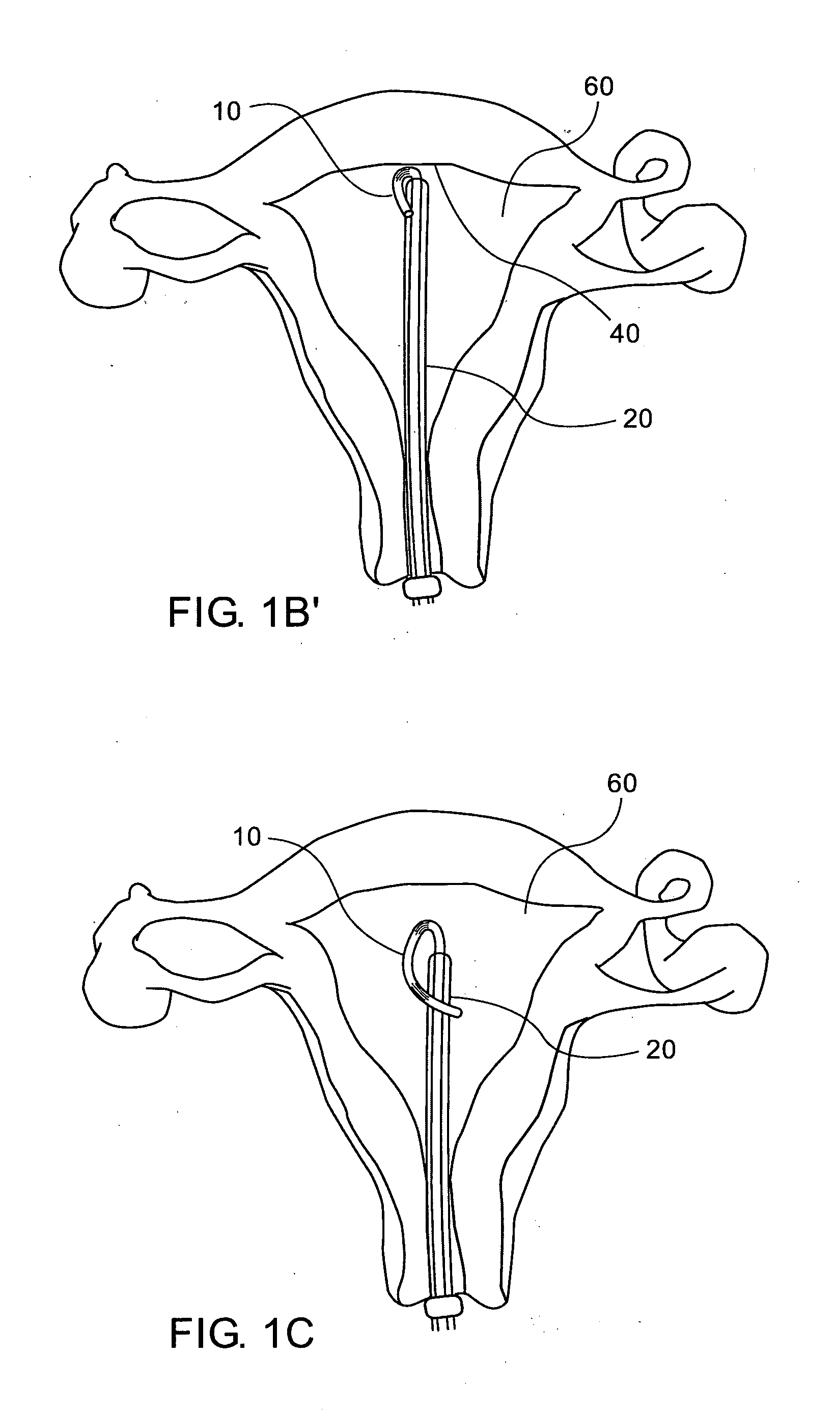 Novel intra uterine device
