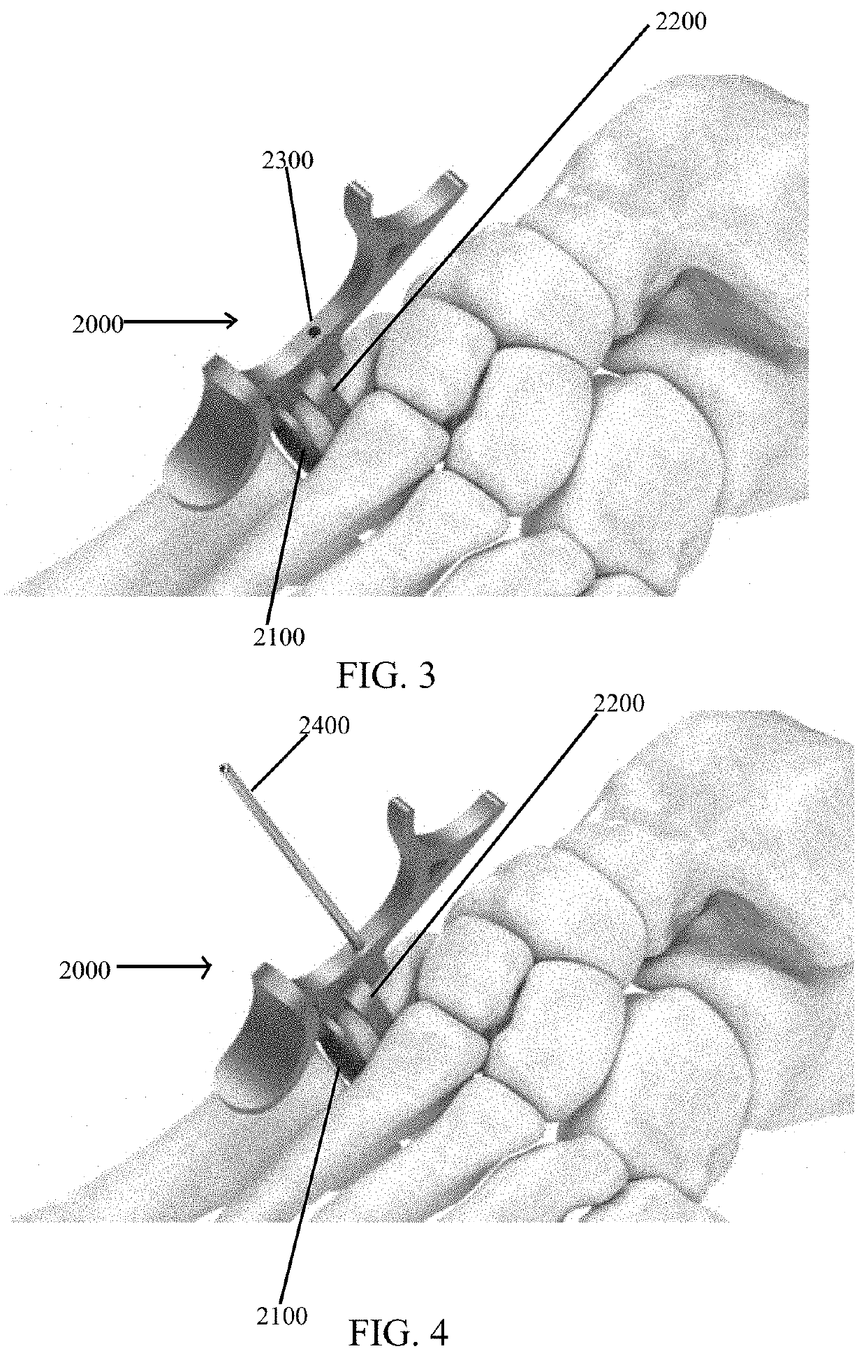 Bone defect repair apparatus and method