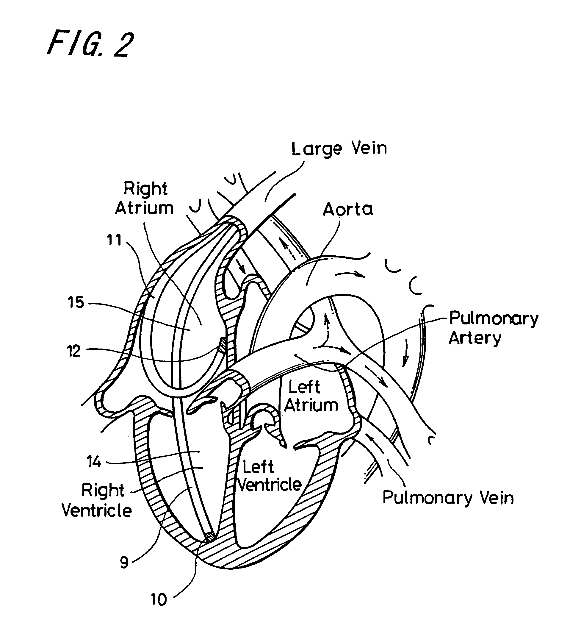 Heart treatment equipment and method for preventing fatal arrhythmia