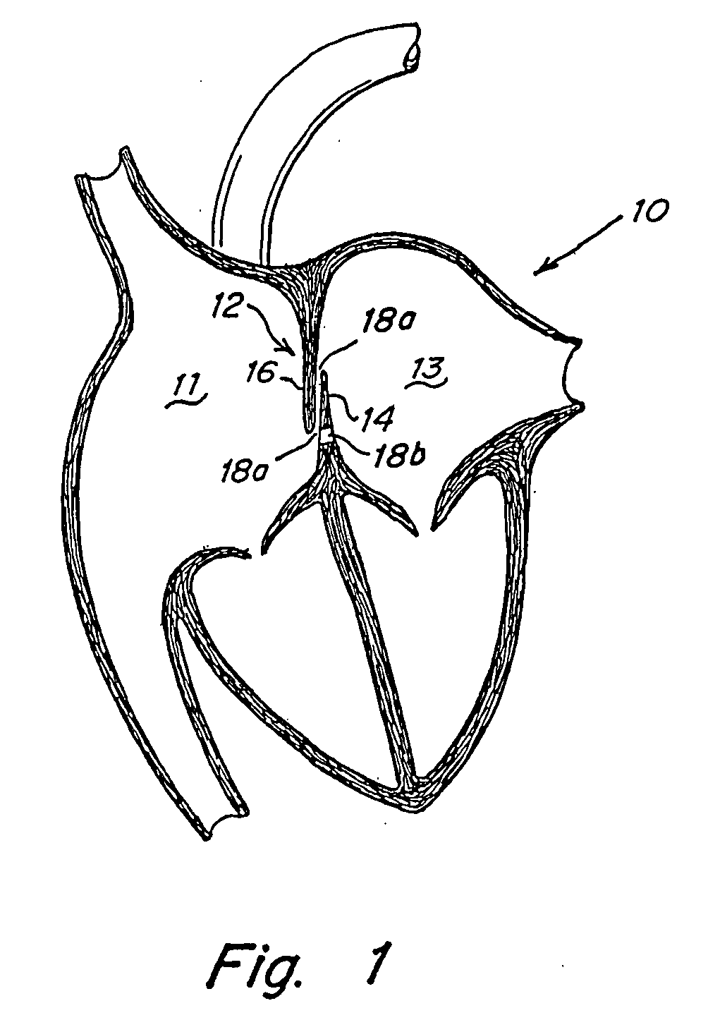 Screw catch mechanism for PFO occluder and method of use