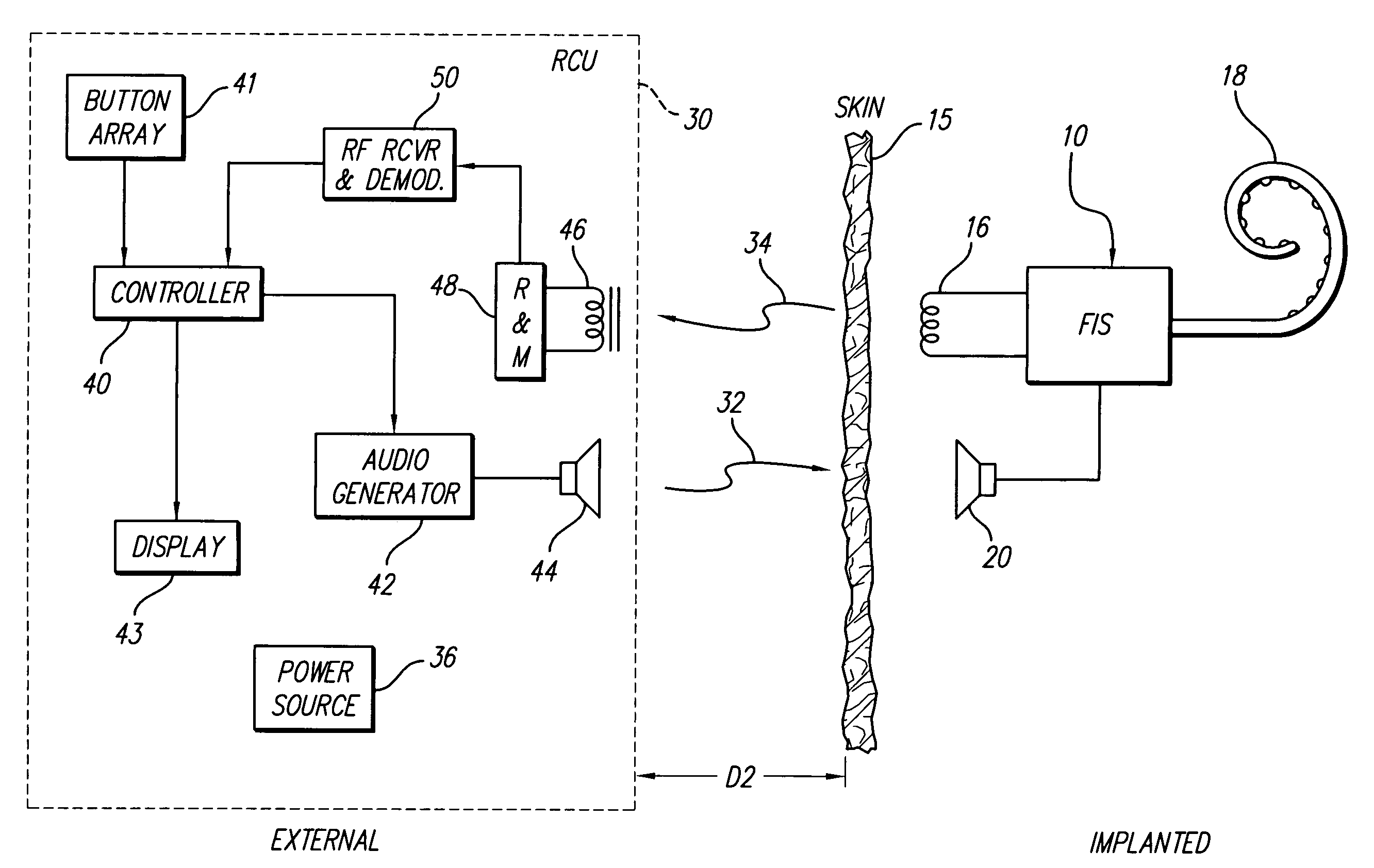 Remote control unit for use with an implantable neural stimulator system