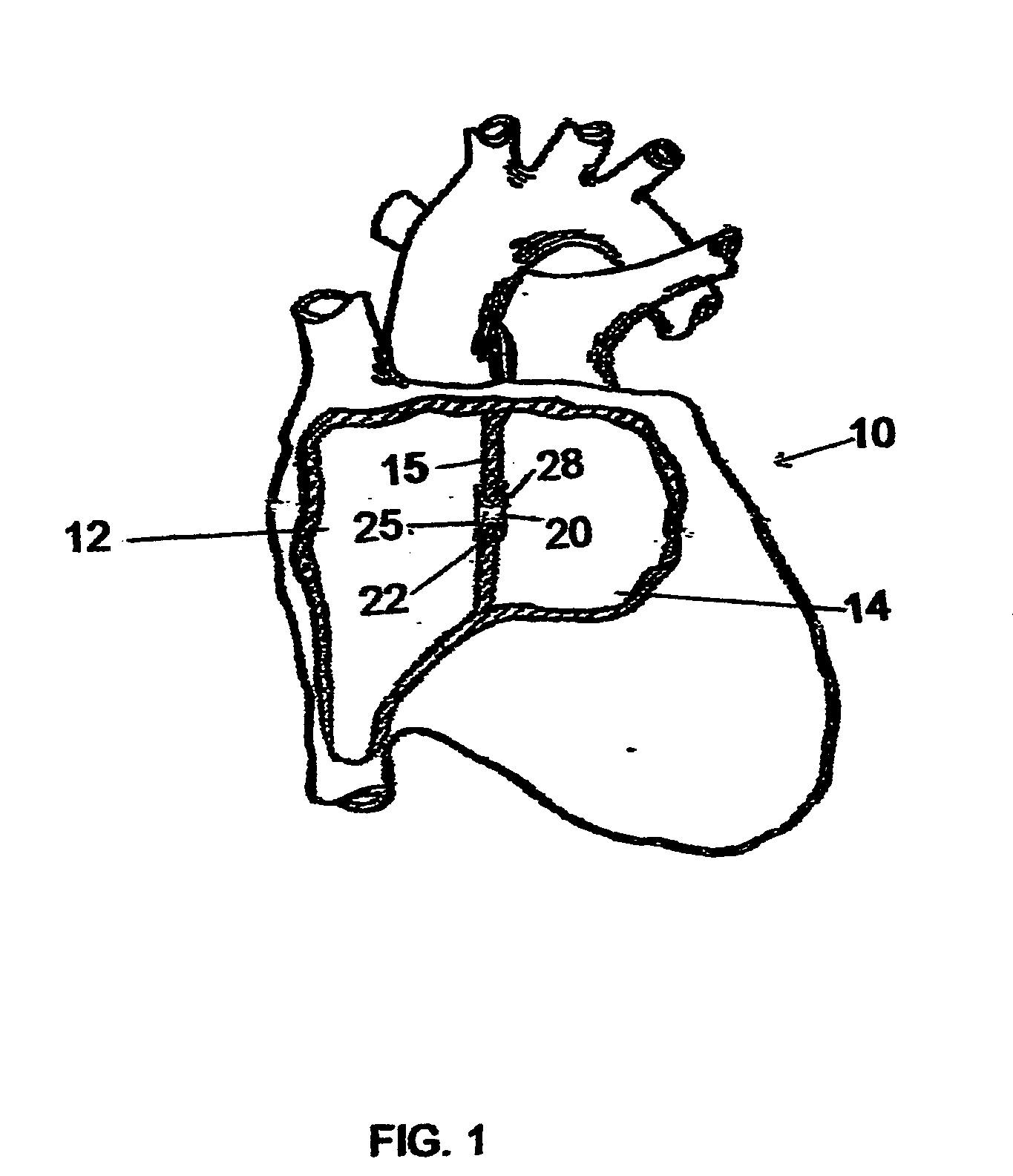 Implantable chamber for biological induction or enhancement of muscle contraction