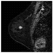 Method and device for judging whether breast mass is benign or malignant