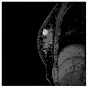 Method and device for judging whether breast mass is benign or malignant