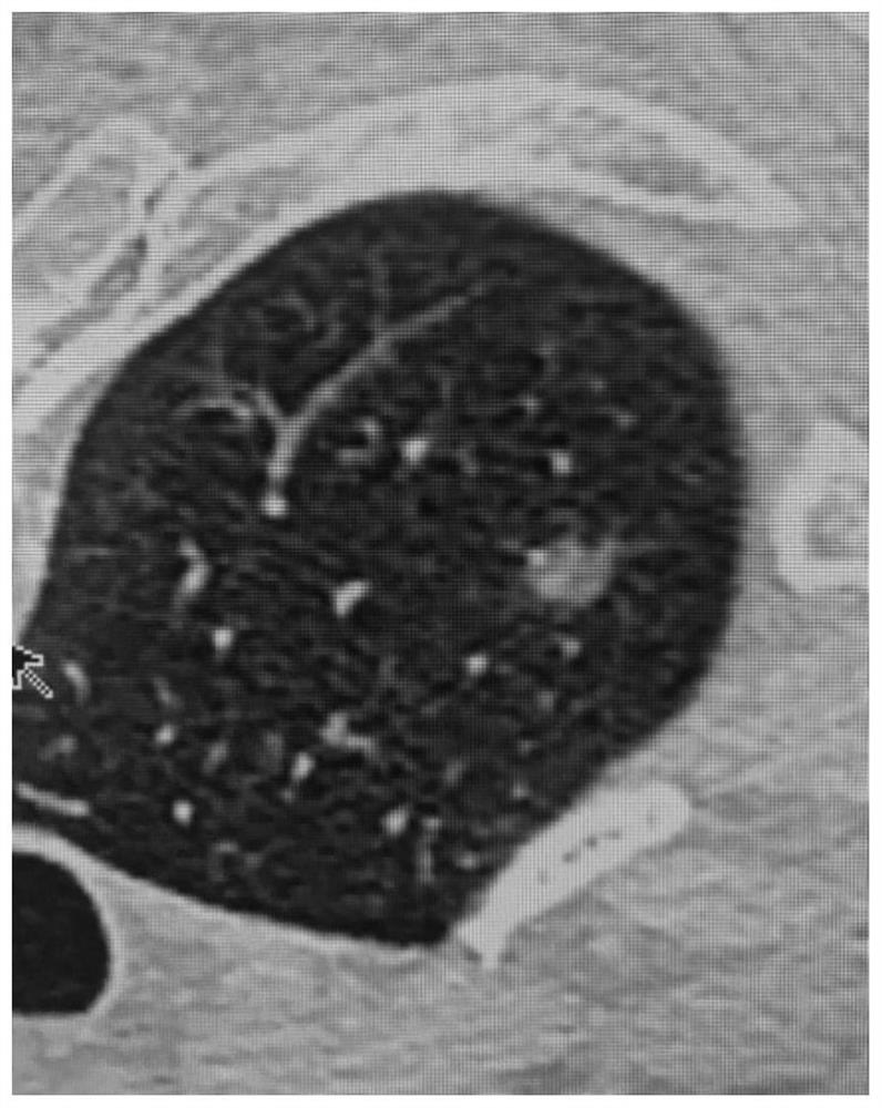 Microwave ablation antenna for treating GGO