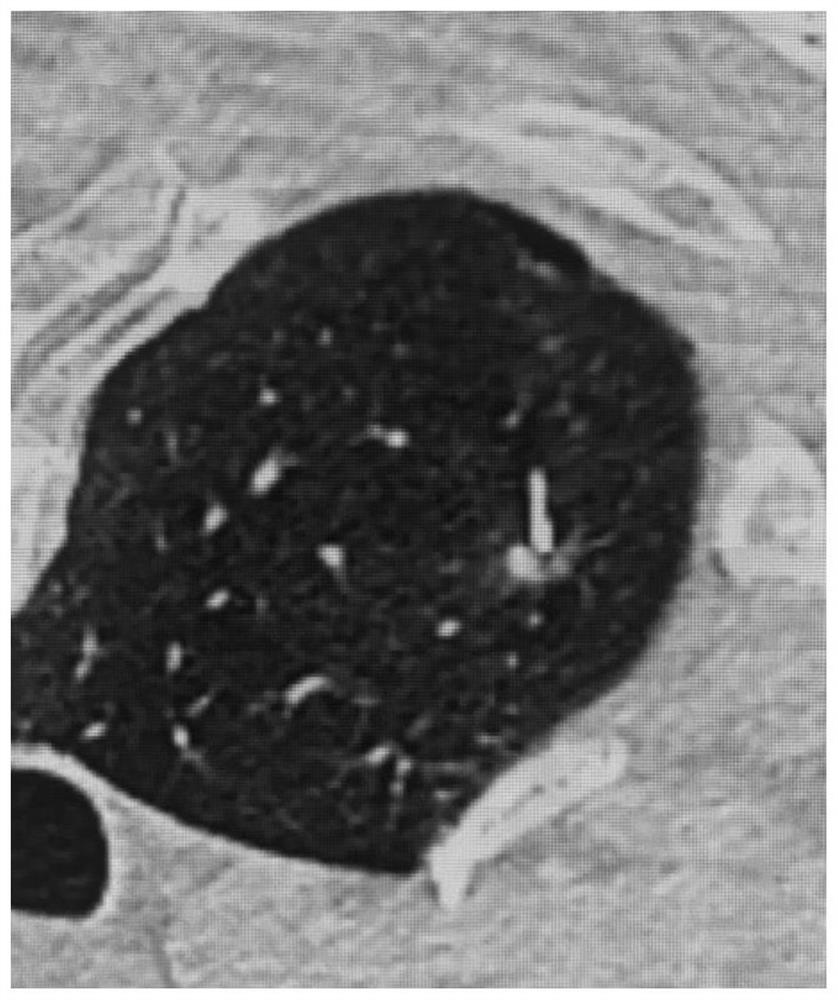 Microwave ablation antenna for treating GGO