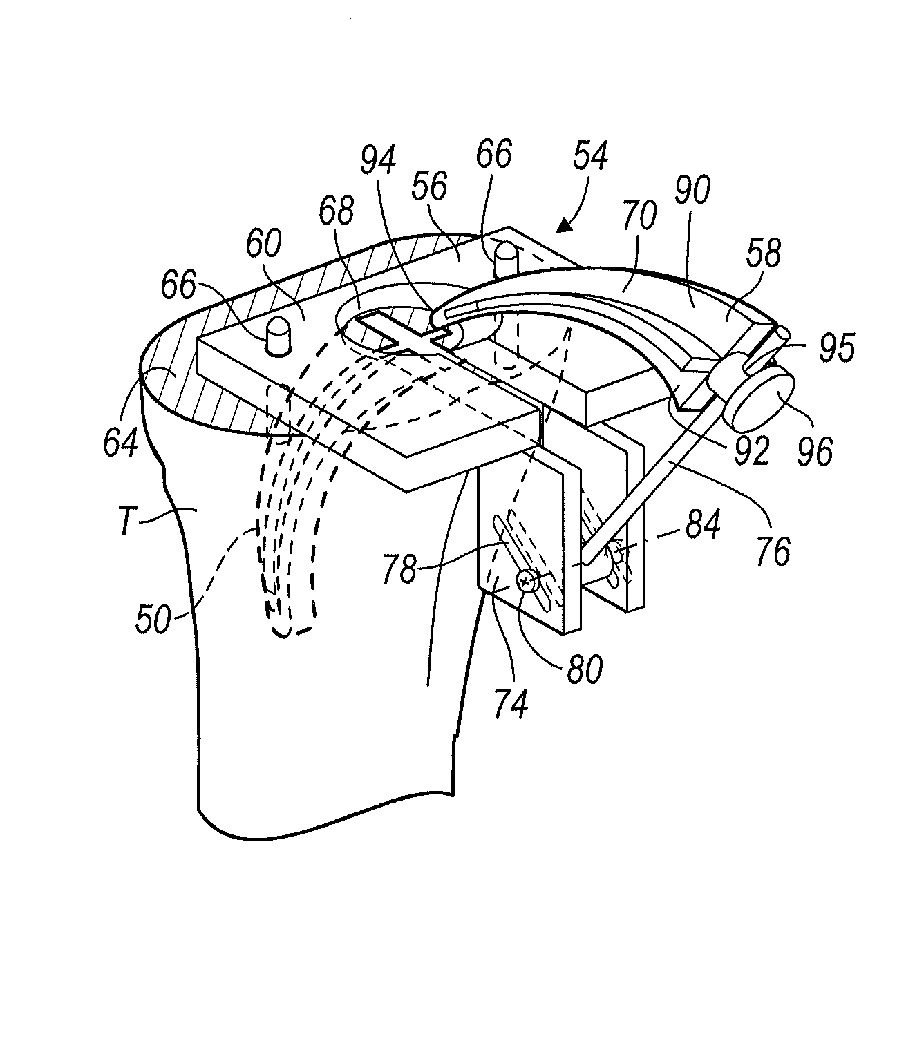 Instrumentation And Method For Implanting A Curved Stem Tibial Tray