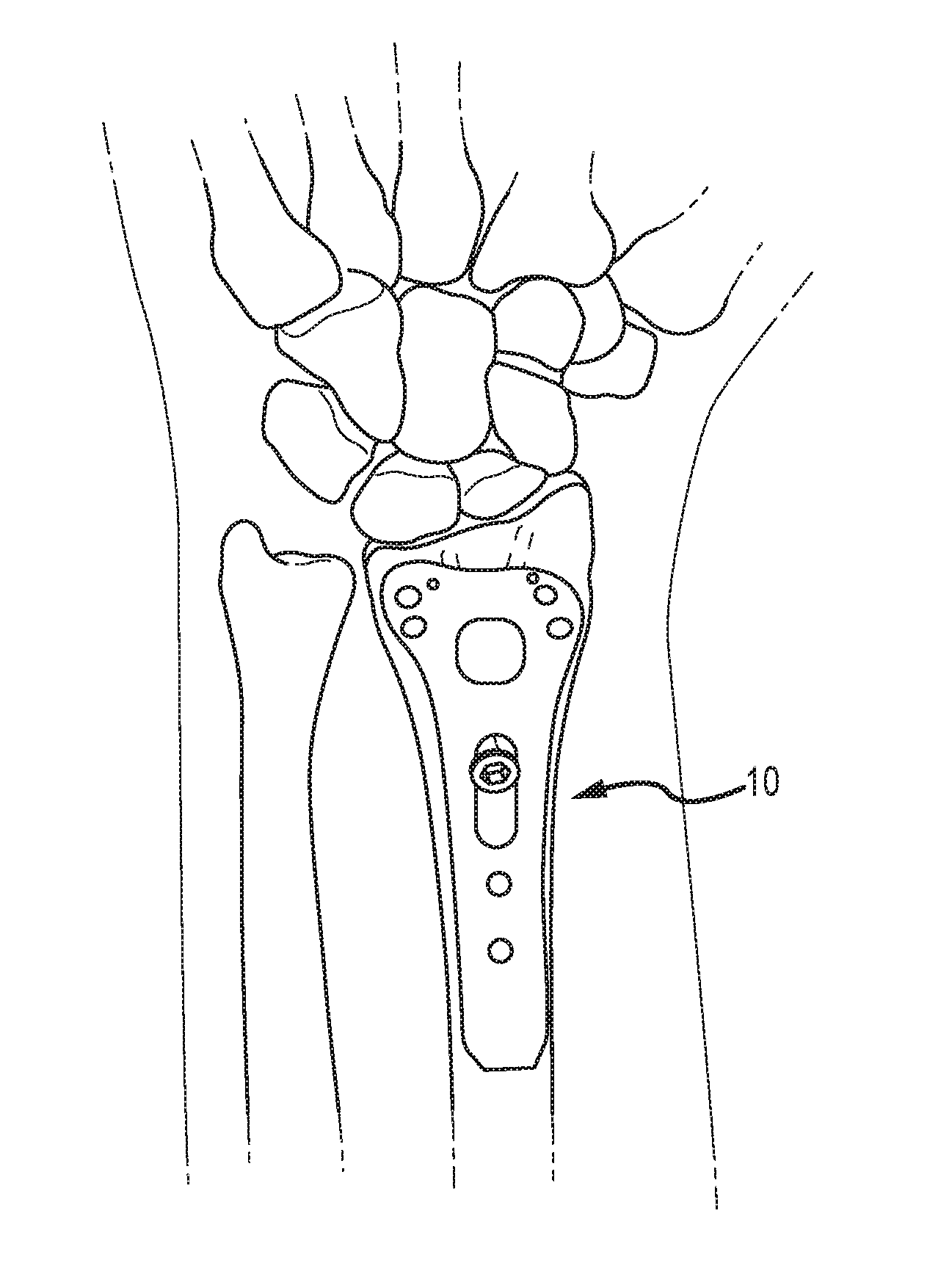 Distal radius plate