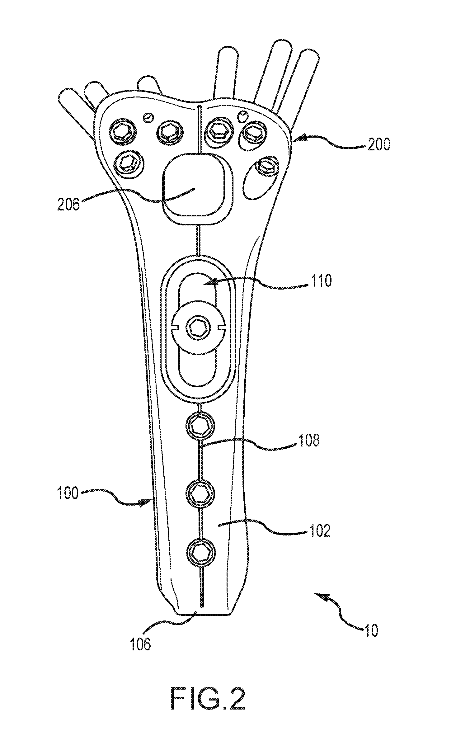 Distal radius plate