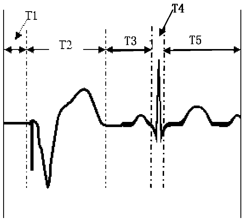 Pace-making electrocardio-signal non-equilibrium deep compression method