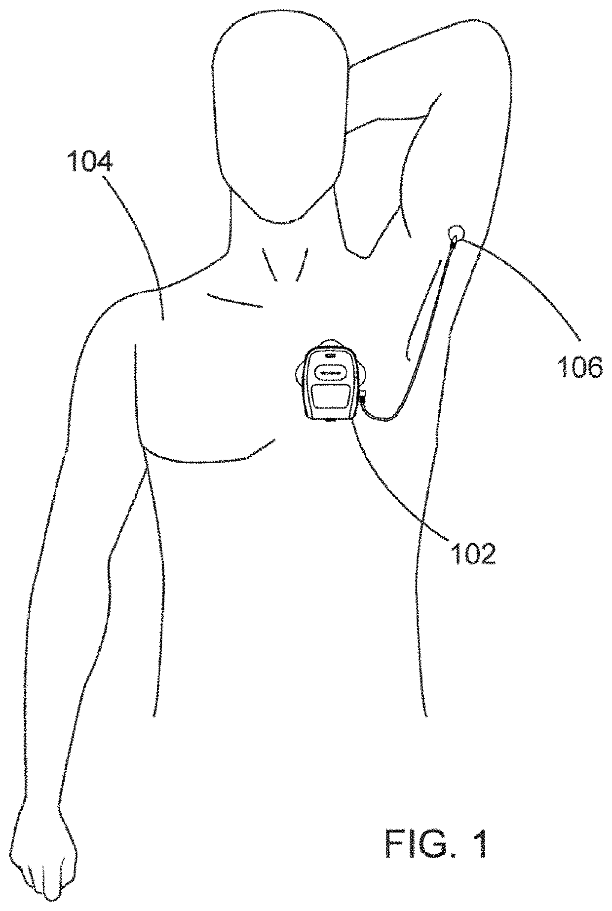 Patient-worn sensor including compliant flexible printed circuit assembly