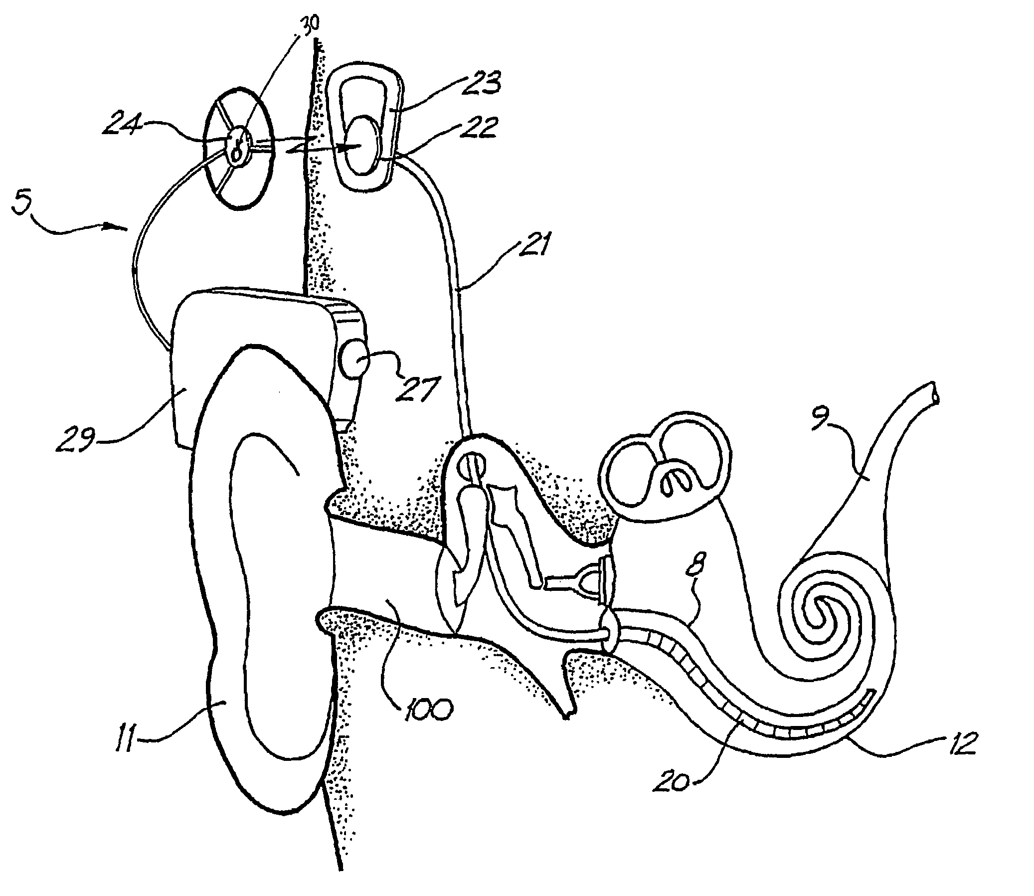 Monitor for auditory prosthesis