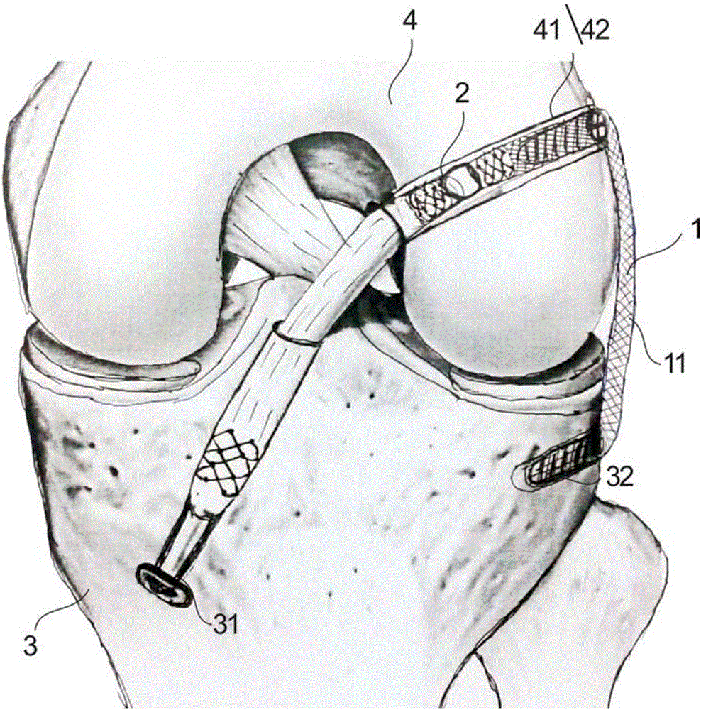 Fixing device and method for integral reconstruction of anterior cruciate ligament and anterolateral ligament