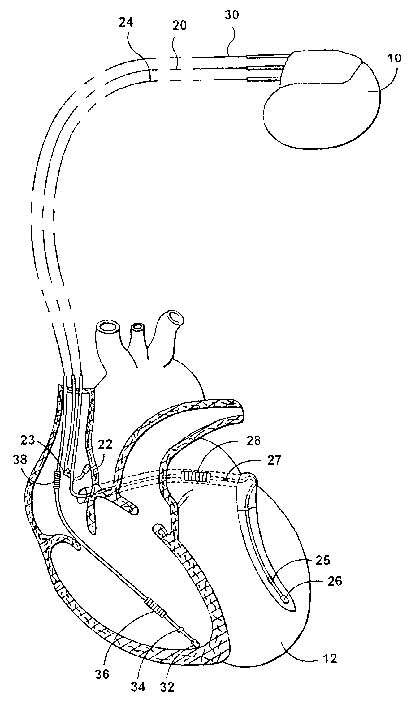 Multi-site cardiac stimulation device and method for detecting retrograde conduction