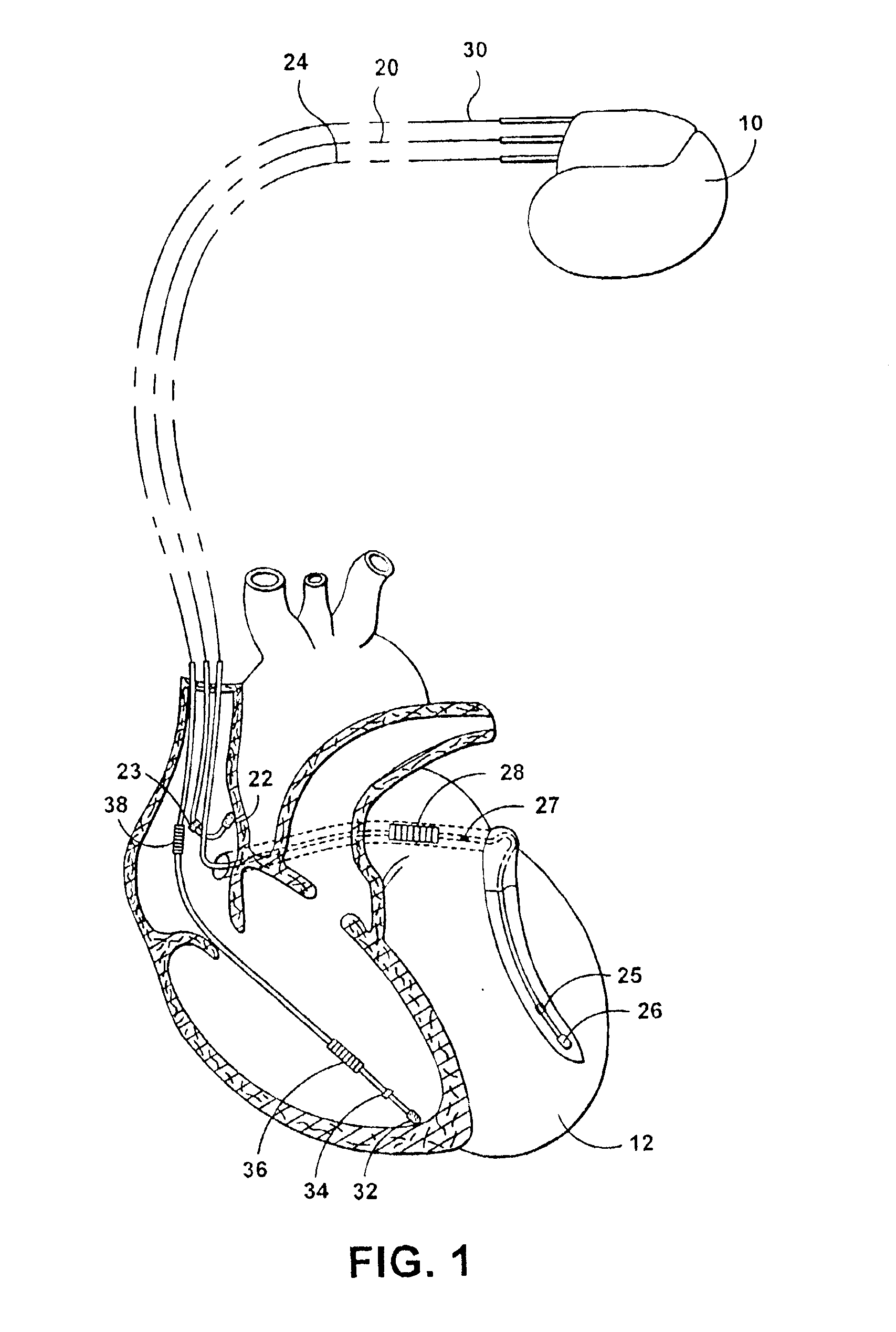 Multi-site cardiac stimulation device and method for detecting retrograde conduction