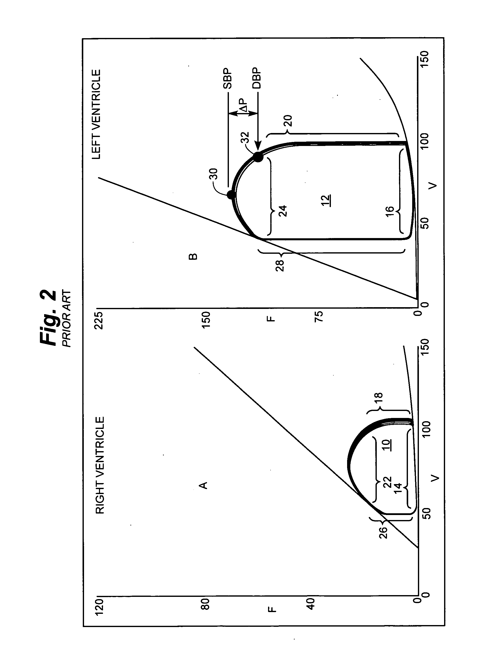 Cardiac stimulation apparatus and method for the control of hypertension