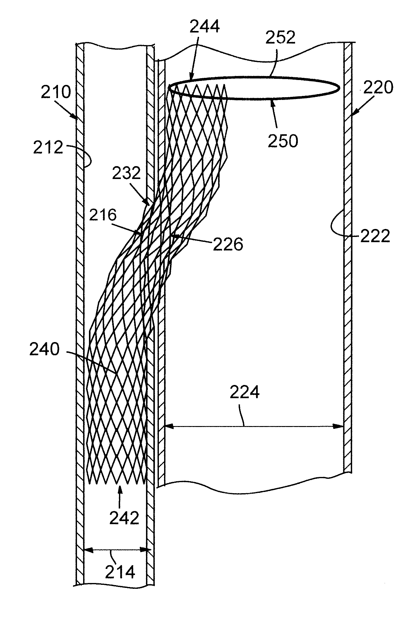 Catheter system with stent device for connecting adjacent blood vessels