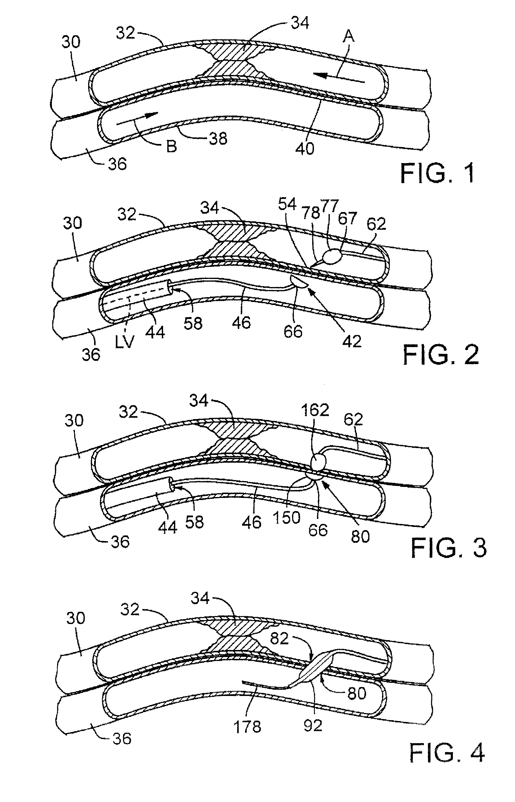 Catheter system with stent device for connecting adjacent blood vessels
