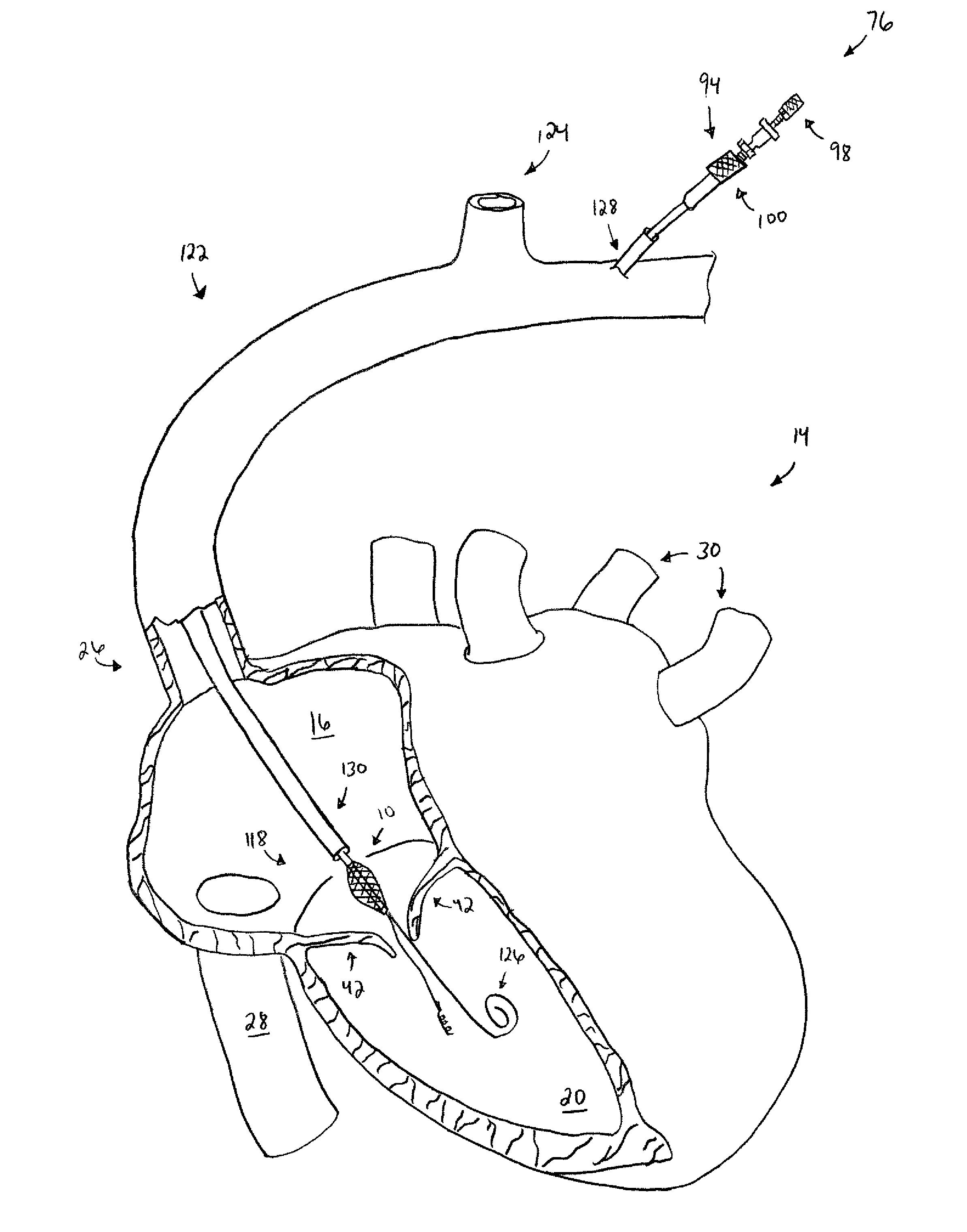 Apparatus, system, and method for treating a regurgitant heart valve
