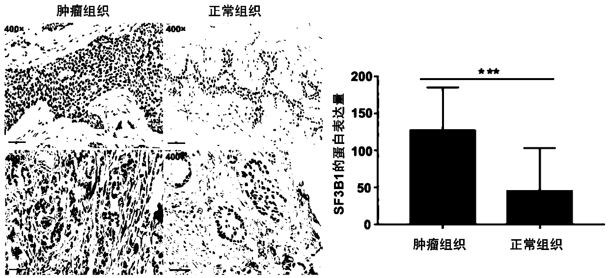 Application of SF3B as target in preparation of drugs for preventing or treating breast cancer
