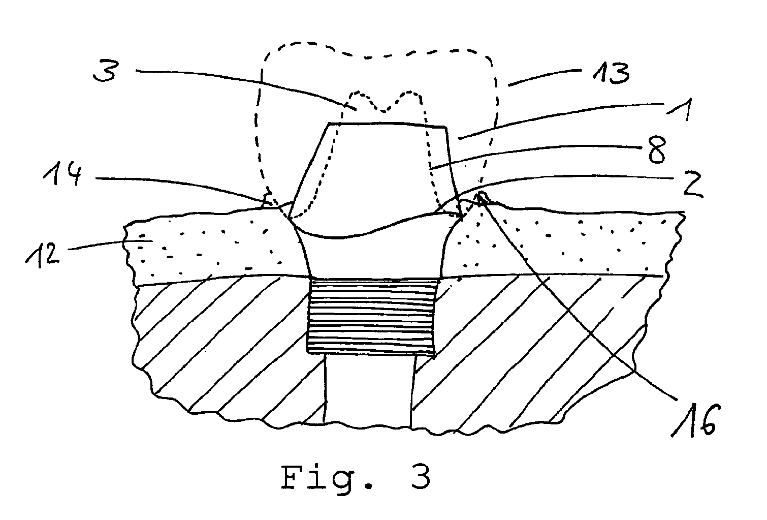 Gingiva former and method for producing a design of a gingiva former