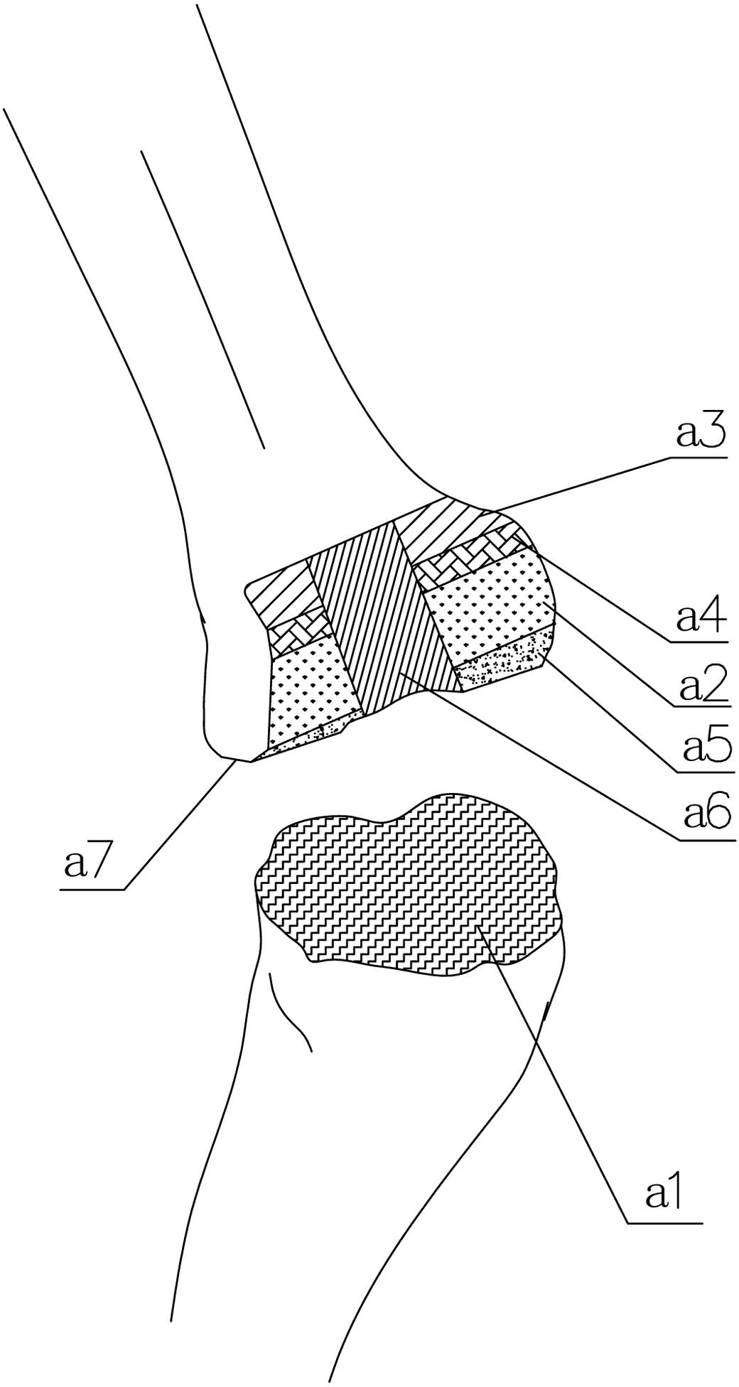 Positioning and bone-cutting system used for minimally invasive artificial knee joint replacement
