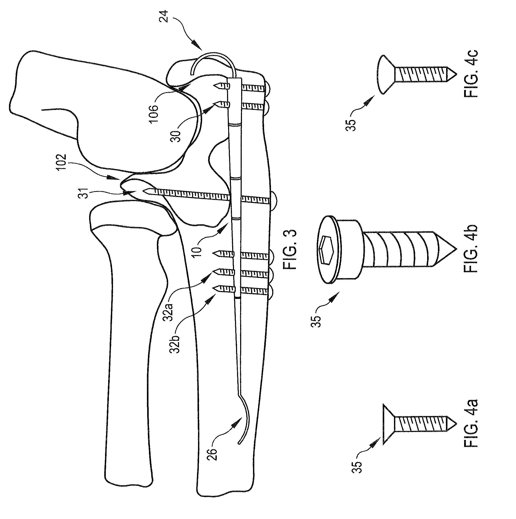 Fixation device for proximal elbow fractures and method of using same