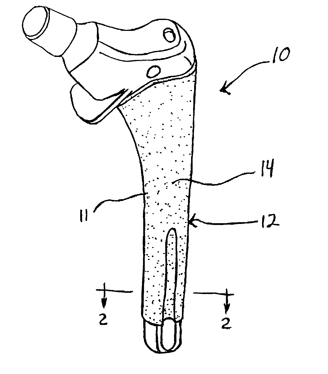 Enhanced fatigue strength orthopaedic implant with porous coating and method of making same