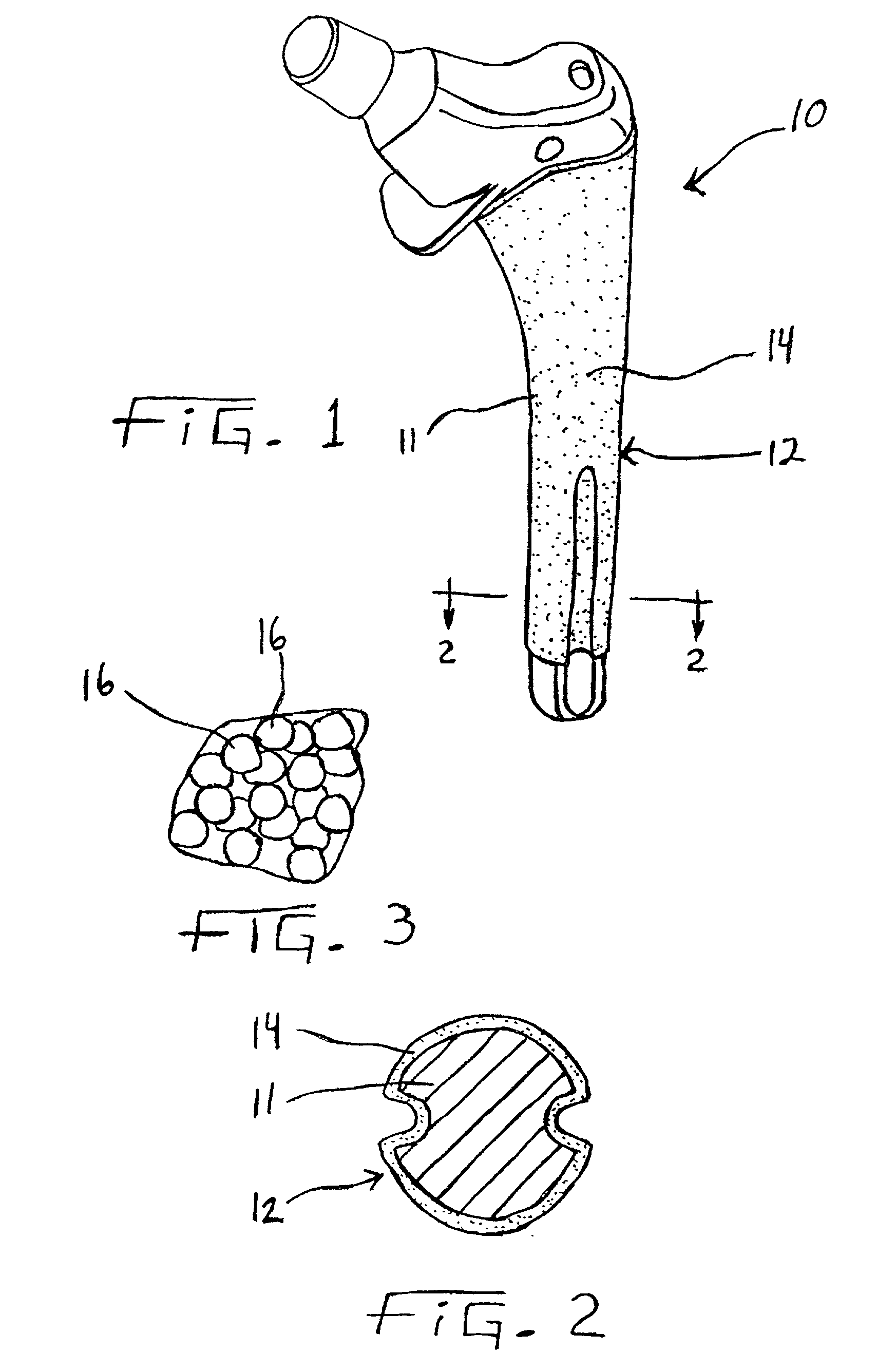 Enhanced fatigue strength orthopaedic implant with porous coating and method of making same