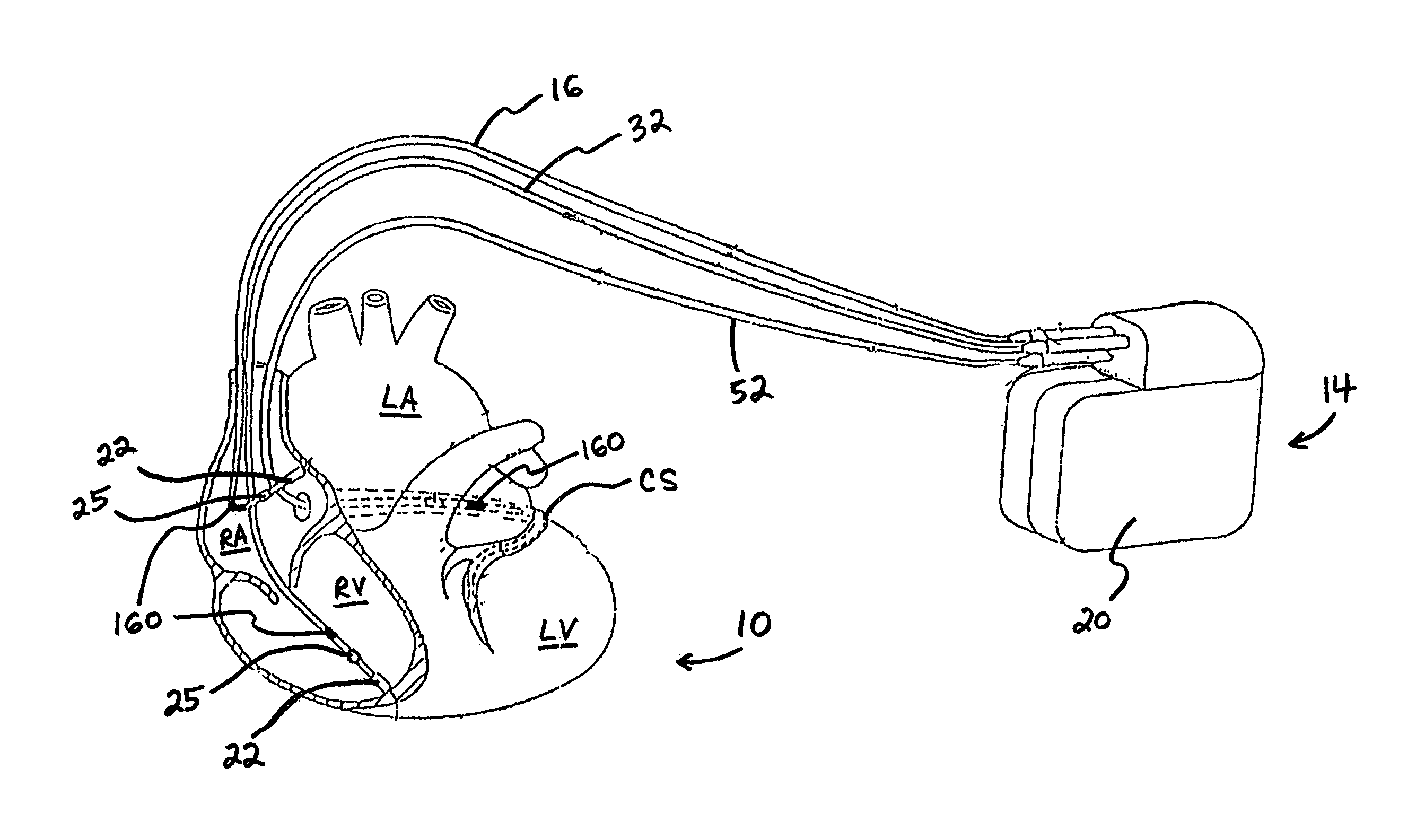 Method and system for controlling pulmonary capillary pressure