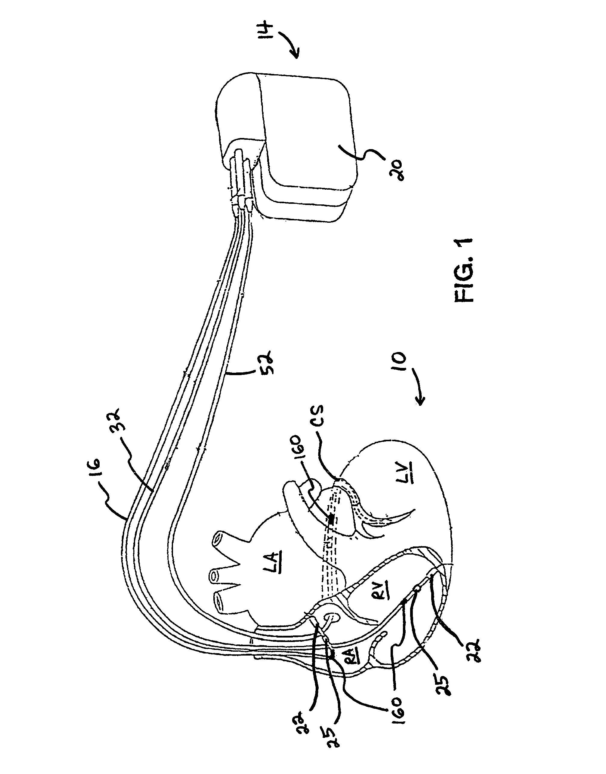 Method and system for controlling pulmonary capillary pressure