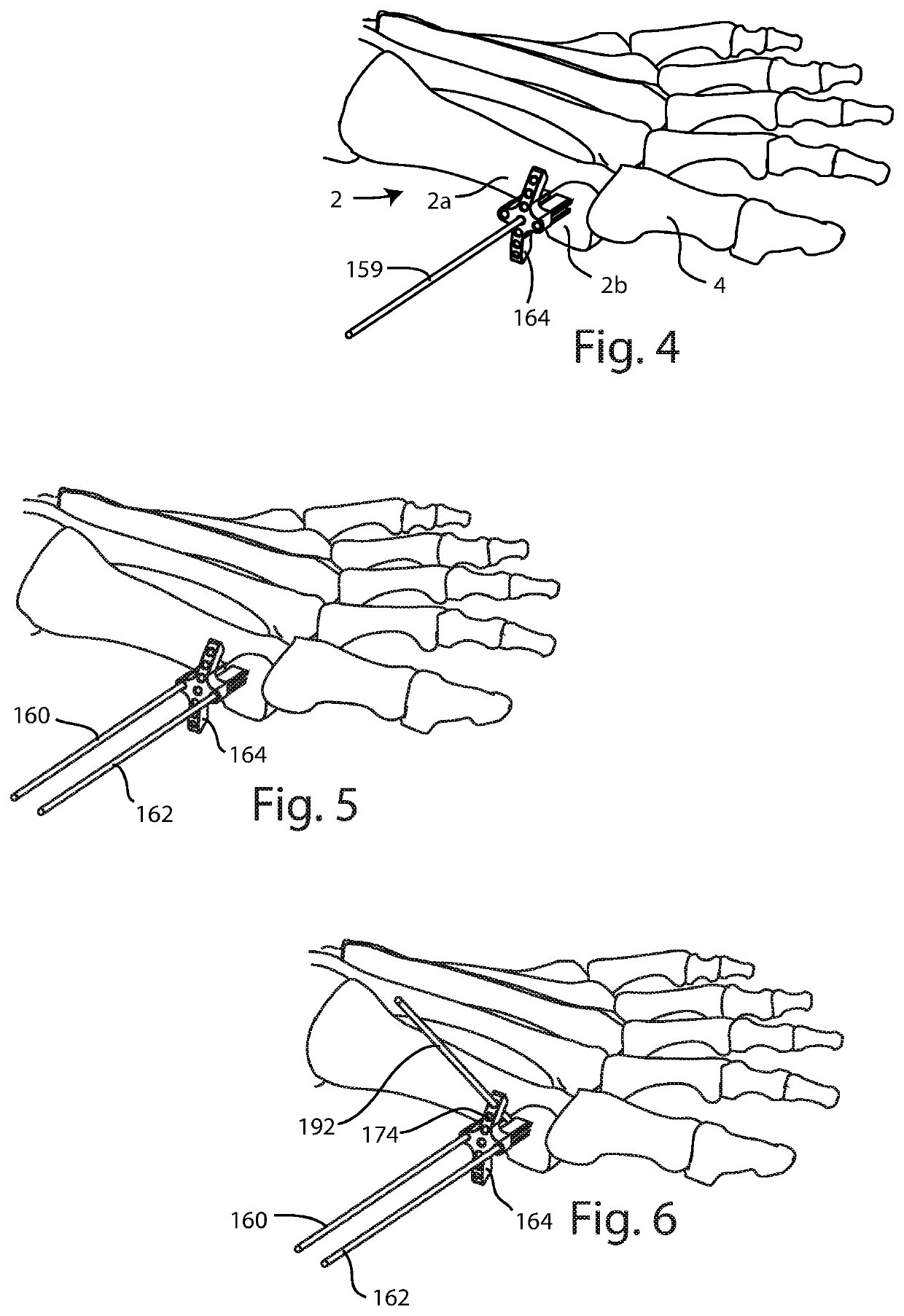 Bunion correction system and method