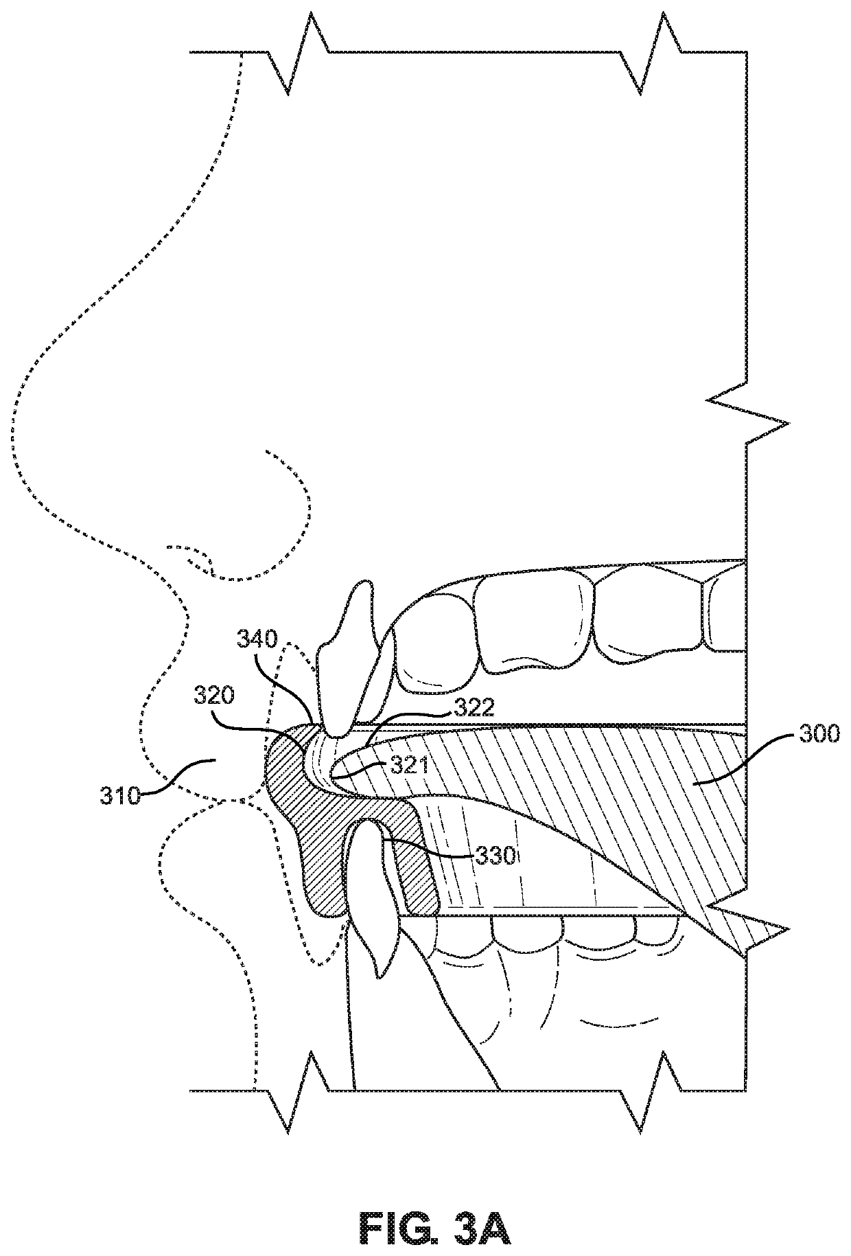 Single arch dental device and method of manufacture