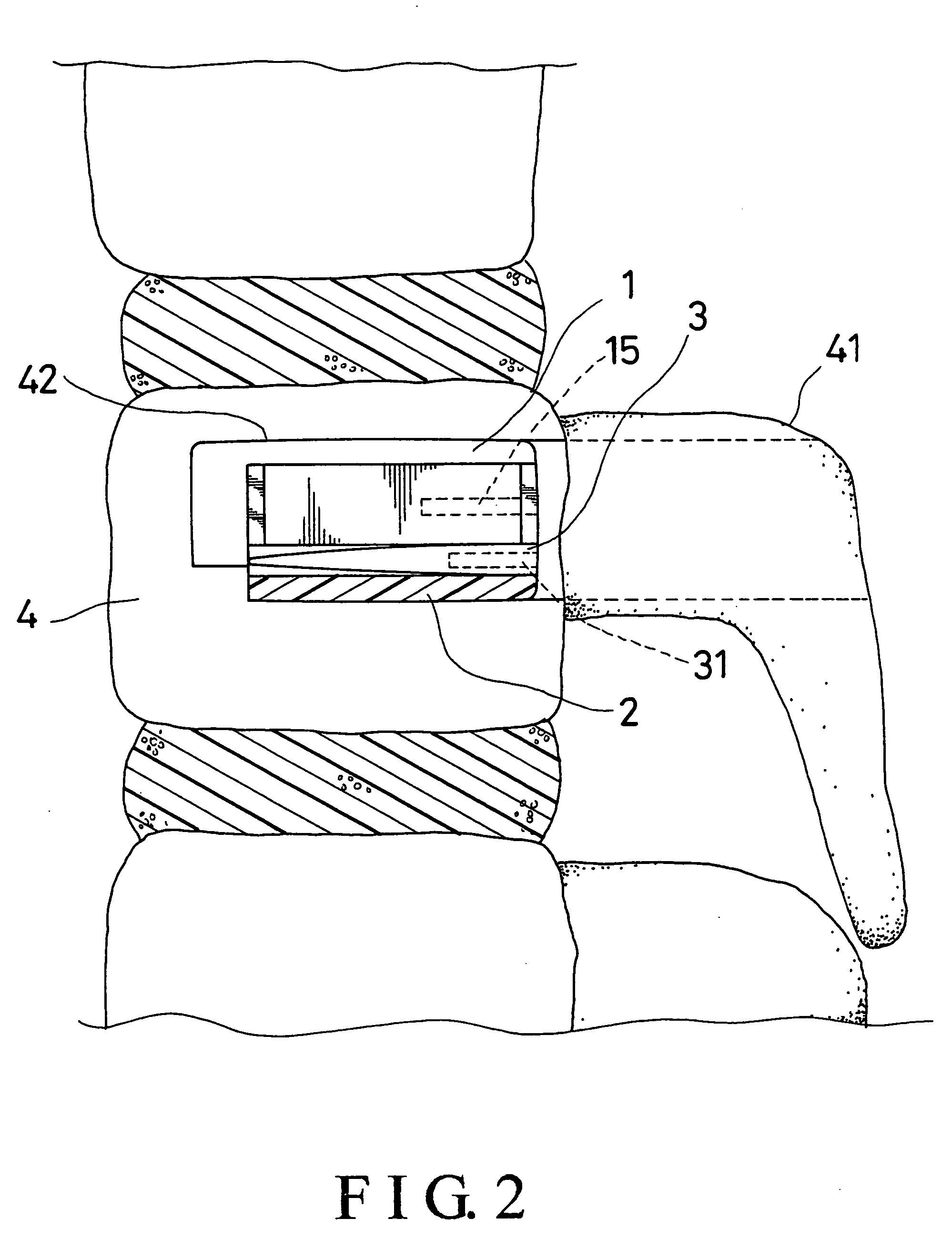 Distractable body augmenter capable of being planted through a pedicle for vertebral body reconstruction