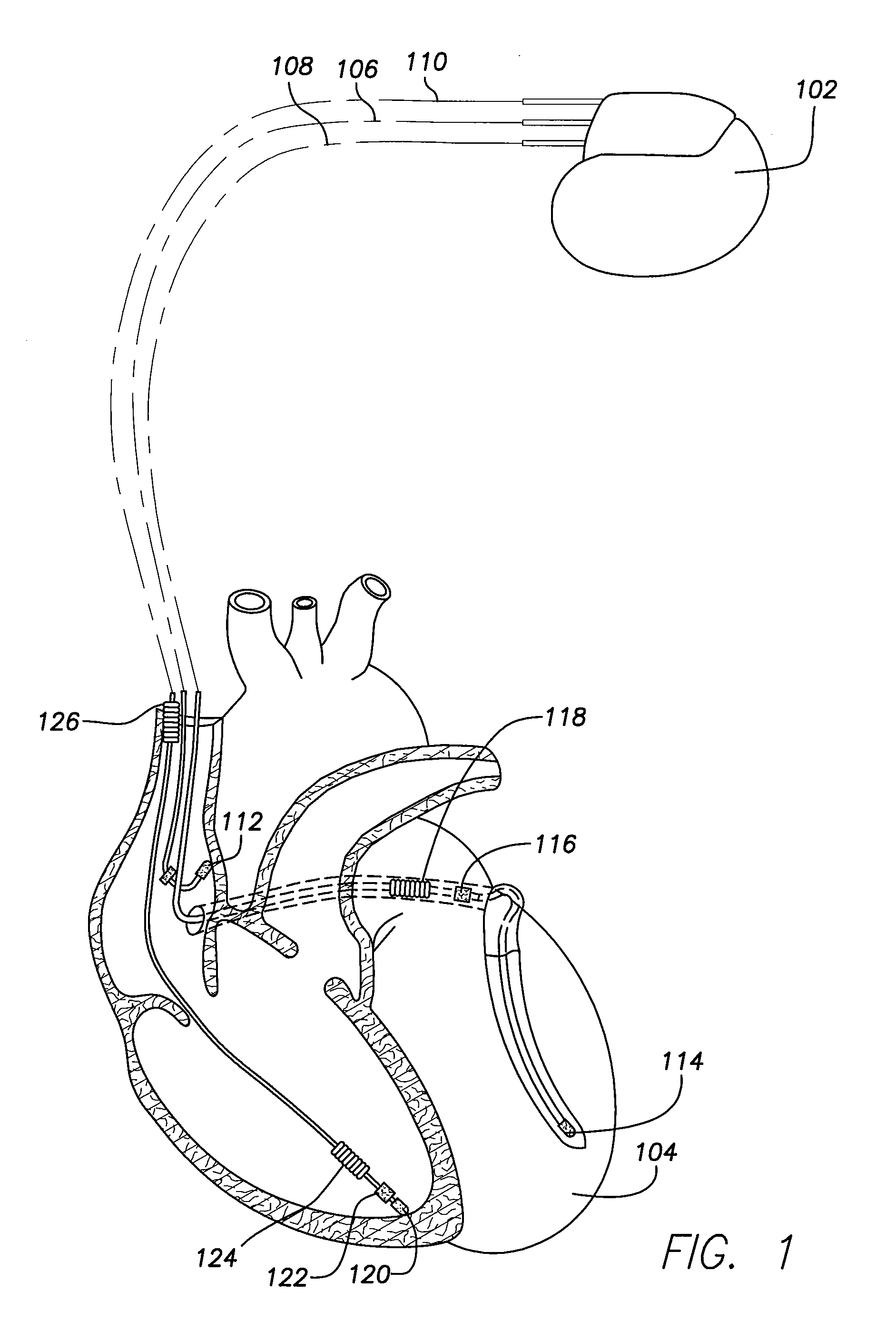 System and method for reducing pain in a high-voltage lead impedance check procedure using DC voltage or current in an implantable medical device