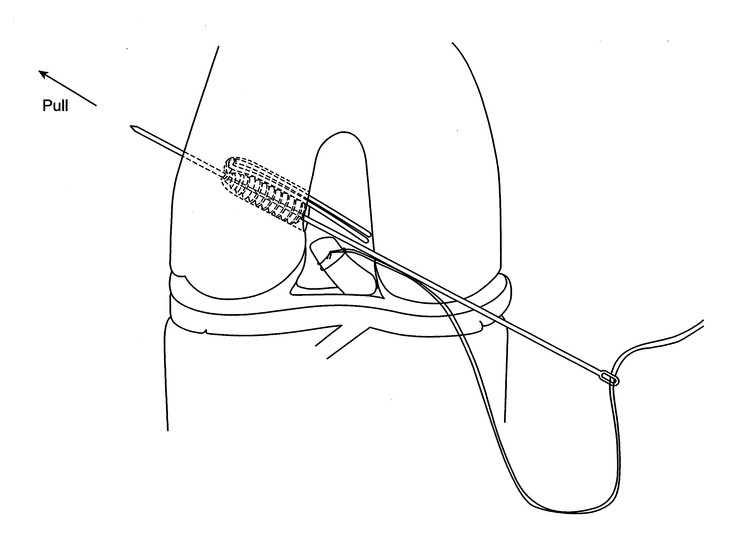 Implant and method for repair of the anterior cruciate ligament