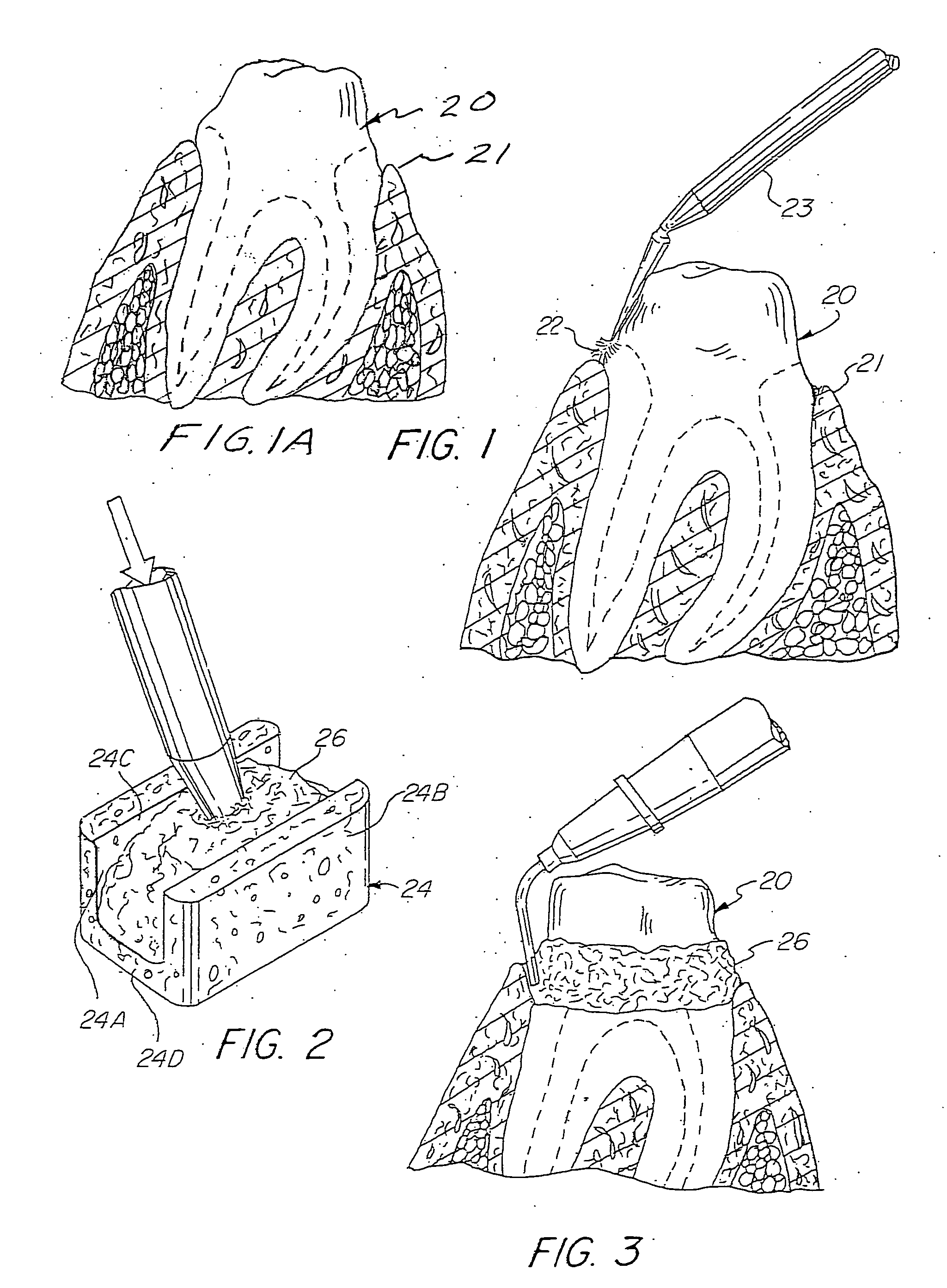 Preloaded dental dam and method for gingival tissue retraction