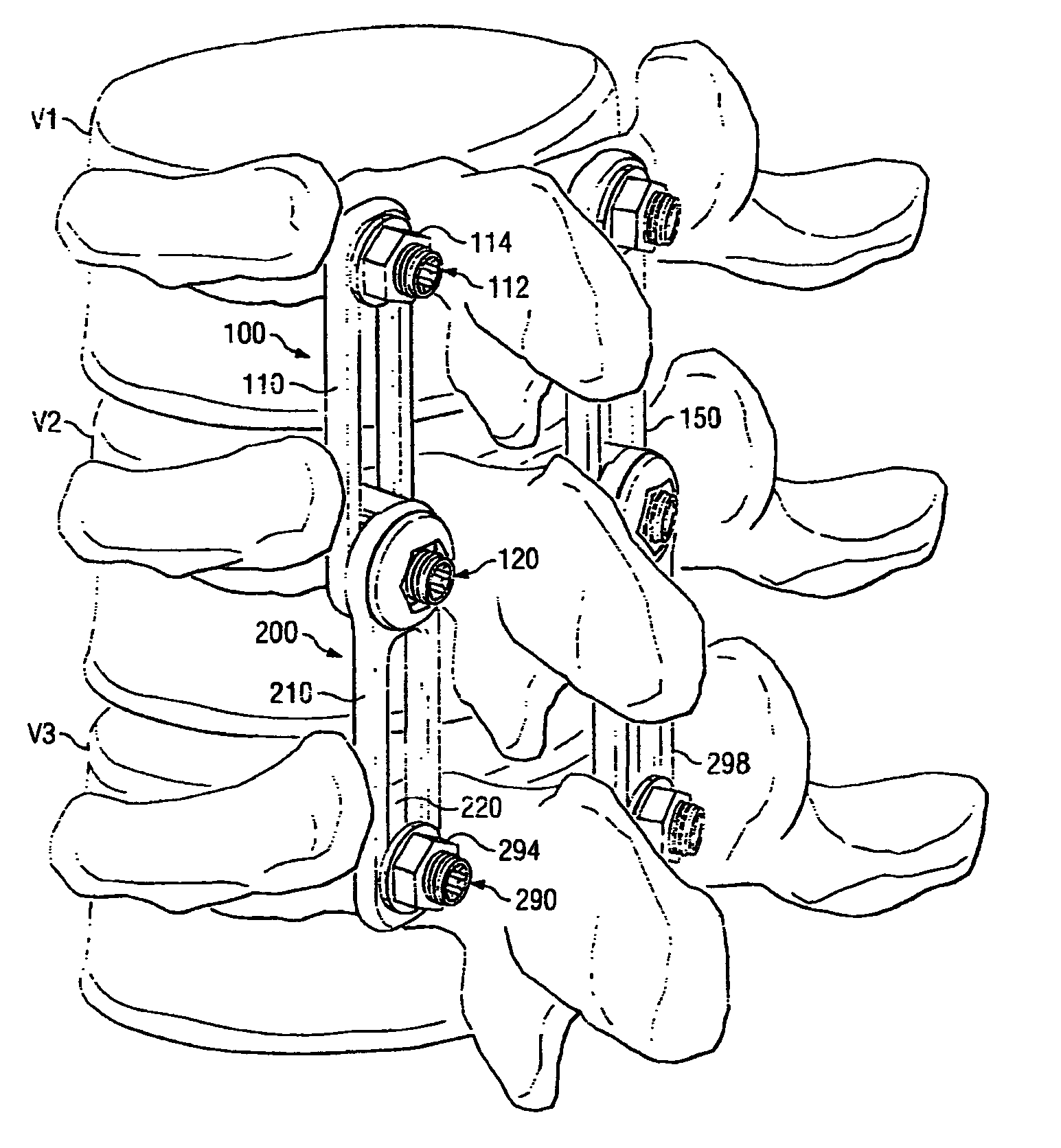 Revision Fixation Plate and Method of Use