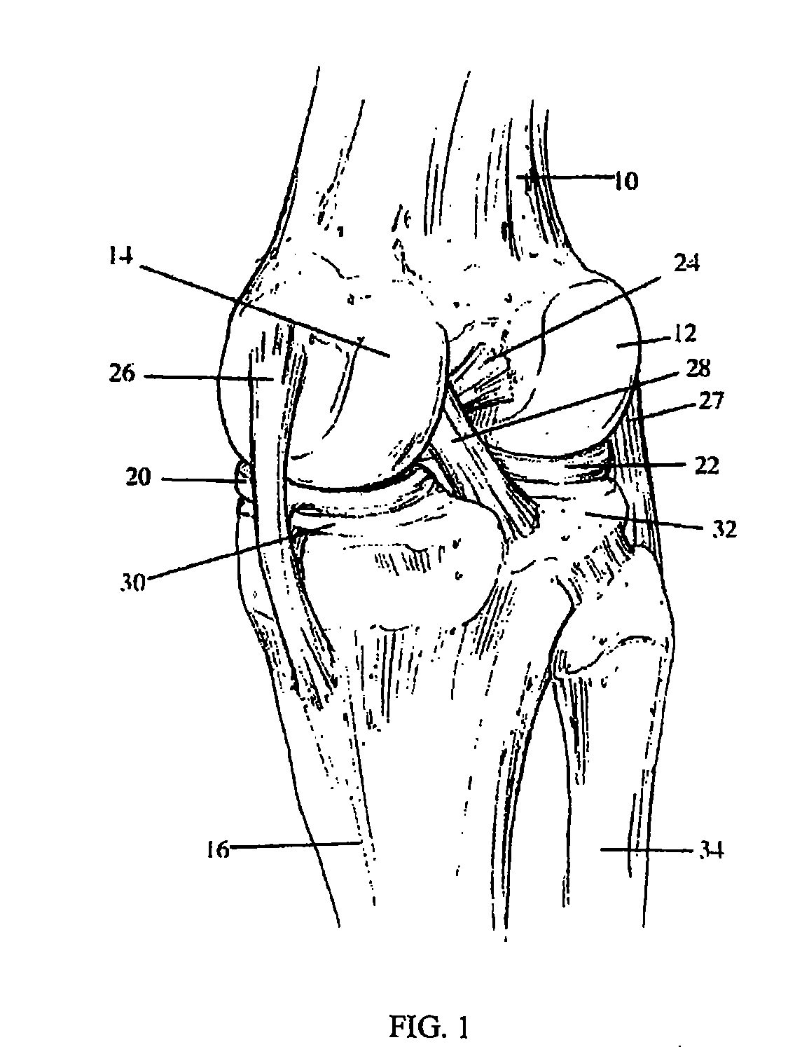 Apparatus and Method for Sculpting the Surface of a Joint